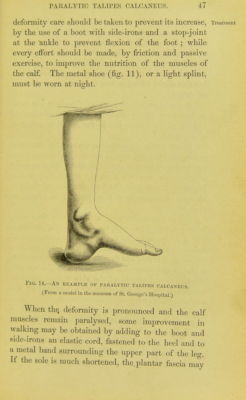 deformity care should be taken to prevent its increase, Treatment by the use of a boot with side-irons and a stop-joint at the ankle to prevent flexion of the foot ; while every effort should be made, by friction and passive exercise, to improve the nutrition of the muscles of the calf. The metal shoe (fig. 11), or a light splint, must be worn at night. Fig. 14.—An example op paralytic talipes calcaneus. (From a model in the museum of St. George's Hospital.) When thq deformity is pronounced and the calf muscles remain paralysed, some improvement in walking may be obtained by adding to the boot and side-irons an elastic cord, fastened to the heel and to a metal band surrounding the upper part of the leo-. If the sole is much shortened, the. plantar fascia may