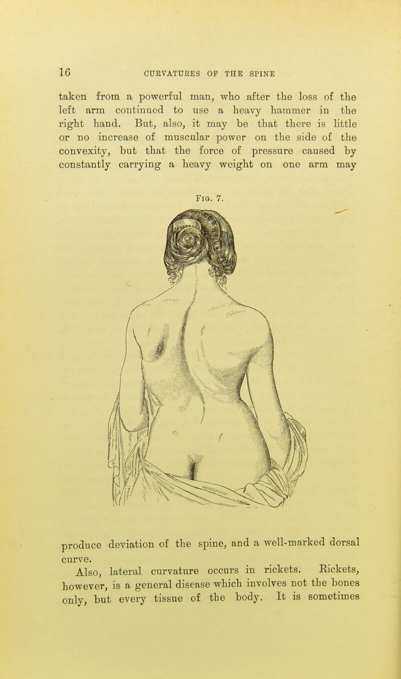 taken from a powerful man, who after the loss of the left arm continued to use a heavy hammer in the right hand. But, also, it may be that there is little or no increase of muscular power on the side of the convexity, but that the force of pressure caused by constantly carrying a heavy weight on one arm may Fig. 7. produce deviation of the spine, and a well-marked dorsal curve. Also, lateral curvature occurs in rickets. Rickets, however, is a general disease which involves not the bones only, but every tissue of the body. It is sometimes