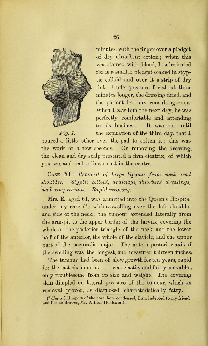 minutes, with the finger over a pledget of dry absorbent cotton; when this was stained with blood, I substituted for it a similar pledget soaked in styp- tic colloid, and over it a strip of dry lint. Under pressure for about three minutes longer, the dressing dried, and the patient left my consulting-room. When I saw him the next day, he was perfectly comfortable and attending to his business. It was not until Fig. 1. the expiration of the third day, that I poured a little ether over the pad to soften it; this was the work of a few seconds. On removing the dressing, the clean and dry scalp presented a firm cicatrix, of which you see, and feel, a linear cast in the centre. Case XL—Removal of large lipoma from neck and showld3r, Stypt'iG colloid, dmin%ge, absorbent dressings, and compression. Rapid recovery. Mrs. E., aged 61, was aimitted into the Queen's Hospita under my care, (*) with a swelling over the left shoulder and side of the neck; the tumour extended laterally from the arm-pit to the upper border of the larynx, covering the whole of the posterior triangle of the neck and the lower half of the anterior, the whole of the clavicle, and the upper part of the pectoralis major. The antero posterior axis of the swelling was the longest, and measured thirteen inches. The tumour had been of slow growth for ten years, rapid for the last six months. It was elastic, and fairly movable ; only troublesome from its size and weight. The covering skin dimpled on lateral pressure of the tumour, which on removal, proved, as diagnosed, characteristically fatty. (*)For a full report of the case, here coadensed, I am indebted to my friend and former dresser, Mr. Arthur Holdsworth.