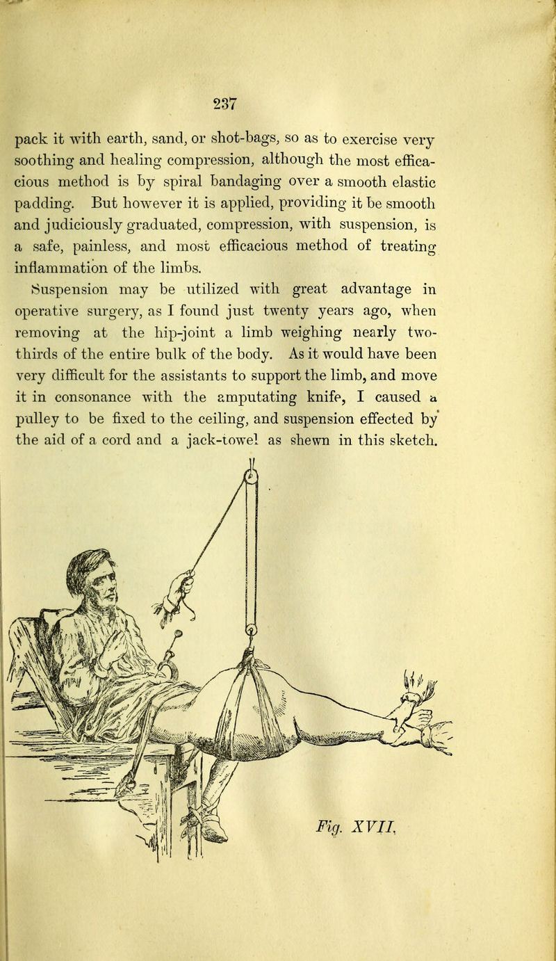 pack it with earth, sand, or shot-bags, so as to exercise very soothing and healing compression, although the most effica- cious method is by spiral bandaging over a smooth elastic padding. But however it is applied, providing it be smooth and judiciously graduated, compression, with suspension, is a safe, painless, and most efficacious method of treating inflammation of the limbs. ^Suspension may be utilized with great advantage in operative surgery, as I found just twenty years ago, when removing at the hip-joint a limb weighing nearly two- thirds of the entire bulk of the body. As it would have been very difficult for the assistants to support the limb, and move it in consonance with the amputating knife, I caused ^ pulley to be fixed to the ceiling, and suspension effected by the aid of a cord and a jack-iow^el as shewn in this sketch.