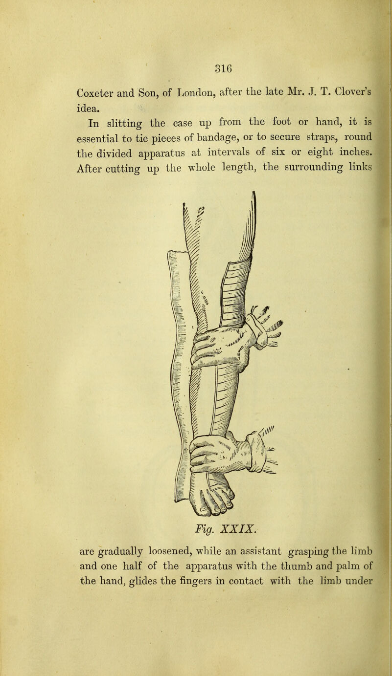 Coxeter and Son, of London, after the late Mr. J. T. Clover's idea. In slitting the case up from the foot or hand, it is essential to tie pieces of bandage, or to secure straps, round the divided apparatus at intervals of six or eight inches.: After cutting up the whole length, the surrounding links Fig. XXIX. are gradually loosened, while an assistant grasping the limb and one half of the apparatus with the thumb and palm of the hand, glides the fingers in contact with the limb under