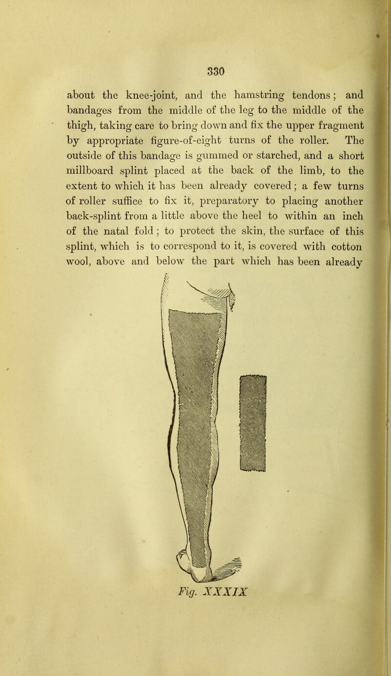 about the knee-joint, and the hamstring tendons; and bandages from the middle of the leg to the middle of the thigh, taking care to bring down and fix the upper fragment by appropriate figure-of-eight turns of the roller. The outside of this bandage is gummed or starched, and a short millboard splint placed at the back of the limb, to the extent to which it has been already covered; a few turns of roller suffice to fix it, preparatory to placing another back-splint from a little above the heel to within an inch of the natal fold; to protect the skin, the surface of this splint, which is to correspond to it, is covered with cotton wool, above and below the part which has been already