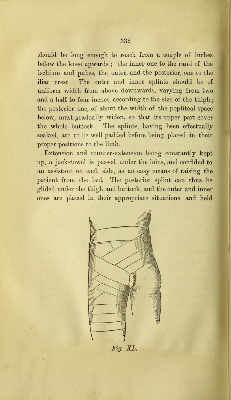 should be long enough to reach from a couple of inches below the knee upwards ; the inner one to the rami of the ischium and pubes, the outer, and the posterior, one to the iliac crest. The outer and inner splints should be of uniform width from above downwards, varying from two and a half to four inches, according to the size of the thigh ; the posterior one, of about the width of the popliteal space below, must gradually widen, so that its upper part cover the whole buttock. The splints, having been effectually soaked, are to be well padded before being placed in their proper positions to the limb. Extension and counter-extension being constantly kept up, a jack-towel is passed under the loins, and confided to an assistant on each side, as an easy means of raising the patient from the bed. The posterior splint can thus be glided under the thigh and buttock, and the outer and inner ones are placed in their appropriate situations, and held Fig. XL.