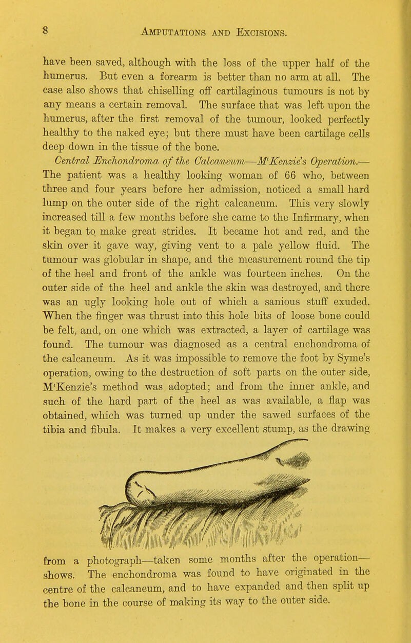 have been saved, although with the loss of the upper half of the humerus. But even a forearm is better than no arm at all. The case also shows that chiselling off cartilaginous tumours is not by any means a certain removal. The surface that was left upon the humerus, after the first removal of the tumour, looked perfectly healthy to the naked eye; but there must have been cartilage cells deep down in the tissue of the bone. Central Enchondroma of the Calcaneum—M'Kenzie's Operation.— The patient was a healthy looking woman of 66 who, between three and four years before her admission, noticed a small hard lump on the outer side of the right calcaneum. Tins very slowly increased till a few months before she came to the Infirmary, when it began to make great strides. It became hot and red, and the ■skin over it gave way, giving vent to a pale yellow fluid. The tumour was globular in shape, and the measurement round the tip of the heel and front of the ankle was fourteen inches. On the outer side of the heel and ankle the skin was destroyed, and there was an ugly looking hole out of which a sanious stuff exuded. When the finger was thrust into this hole bits of loose bone could be felt, and, on one which was extracted, a layer of cartilage was found. The tumour was diagnosed as a central enchondroma of the calcaneum. As it was impossible to remove the foot by Synie's operation, owing to the destruction of soft parts on the outer side, M'Kenzie's method was adopted; and from the inner ankle, and such of the hard part of the heel as was available, a flap was obtained, which was turned up under the sawed surfaces of the tibia and fibula. It makes a very excellent stump, as the drawing from a photograph—taken some months after the operation- shows. The enchondroma was found to have originated in the centre of the calcaneum, and to have expanded and then split up the bone in the course of making its way to the outer side.
