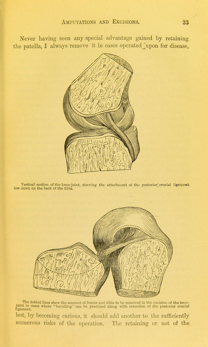 Never having seen any special advantage gained by retaining the patella, I always remove it in cases operatedJupon for disease, Vertical section of the knee-joint, shewing the attachment of the posterior ^crucial ligament low down on the back of the tibia. The dotted lines shew the amount of femur and tibia to bo removed in the excision of the knee- joint in cases where bevelling can be practised along with retention of the posterior crucial ligament. lest, by becoming carious, it should add another to the sufficiently numerous risks of the operation. The. retaining or not of the