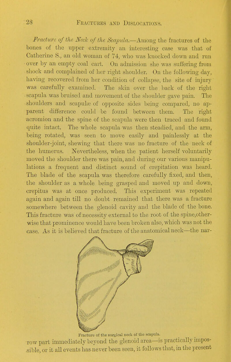 Fraetwre of flu- Mclc of the Scapvla.—Among the fractures of the bones of the upper extremity an interesting case was that of Catherine S., an old woman of 74, who was knocked down and run •over by an empty coal cart. On admission she was suffering from shock and complained of her right shoulder. On the following day, having recovered from her condition of collapse, the site of injury was carefully examined. The skin over the back of the right scapula was bruised and movement of the shoulder gave pain. The shoulders and scapulas of opposite sides being compared, uo ap- parent difference could be found between them. The right acromion and the spine of the scapula were then traced and found tpiite intact. The whole scapula was then steadied, and the arm, being rotated, was seen to move easily and painlessly at the shoulder-joint, shewing that there was no fracture of the neck of the humerus. Nevertheless, when the patient herself voluntarily moved the shoulder there was pain, and during our various manipu- lations a frequent and distinct sound of crepitation was heard. The blade of the scapula was therefore carefully fixed, and then, the shoulder as a whole being grasped and moved up and down, crepitus was at once produced. This experiment was repeated again and again till no doubt remained that there was a fracture somewhere between the glenoid cavity and the blade of the bone. This fracture was of necessity external to the root of the spine,other- wise that prominence would have been broken also, which was not the case. As it is believed that fracture of the anatomical neck—the nar- Fraoturo of the surgical neck of the scapula. row part immediately beyond the glenoid area—is practically impos- sible, or it all events has never been seen, it follows that, in the present