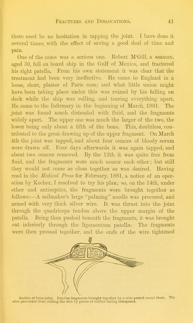 there need be no hesitation in tapping the joint. I have done it several times; with the effect of saving a good deal of time and pain. One of the cases was a serious one. Bobert M'Gill, a seaman, aged 30, fell on board ship in the Gulf of Mexico, and fractured his right patella. From his own statement it was clear that the treatment had been very ineffective. He came to England in a loose, short, plaster of Paris case; and what little union might have been taking place under this was ruined by his falling on deck while the ship was rolling, and tearing everything apart. He came to the Infirmary in the beginning of March, 1881. The joint was found much distended with fluid, and the fragments widely apart. The upper one was much the larger of the two, the lower being only about a fifth of the bone. This, doubtless, con- tributed to the great drawing up of the upper fragment. On March 4th the joint was tapped, and about four ounces of bloody serum were drawn off. Four clays afterwards it was again tapped, and about two ounces removed. By the 12th it was quite free from fluid, and the fragments were much nearer each other; but still they would not come as close together as was desired. Having read in the Medical Press for February, 1881, a notice of an oper- ation by Kocher, I resolved to try his plan; so, on the 14th, under ether and antiseptics, the fragments were brought together as foUows:—A sailmaker's large palming needle was procured, and armed with very thick silver wire. It was thrust into the joint through the quadriceps tendon above the upper margin of the patella. Being then pushed beneath the fragments, it was brought out inferiorly through the ligamentum patellae. The fragments were then pressed together, and the ends of the wire tightened Section of knee-joint. Patellar fragments brought together by a wire passed round them. The wire prevented from cutting the skin by pieces of rubber tubing interposed.