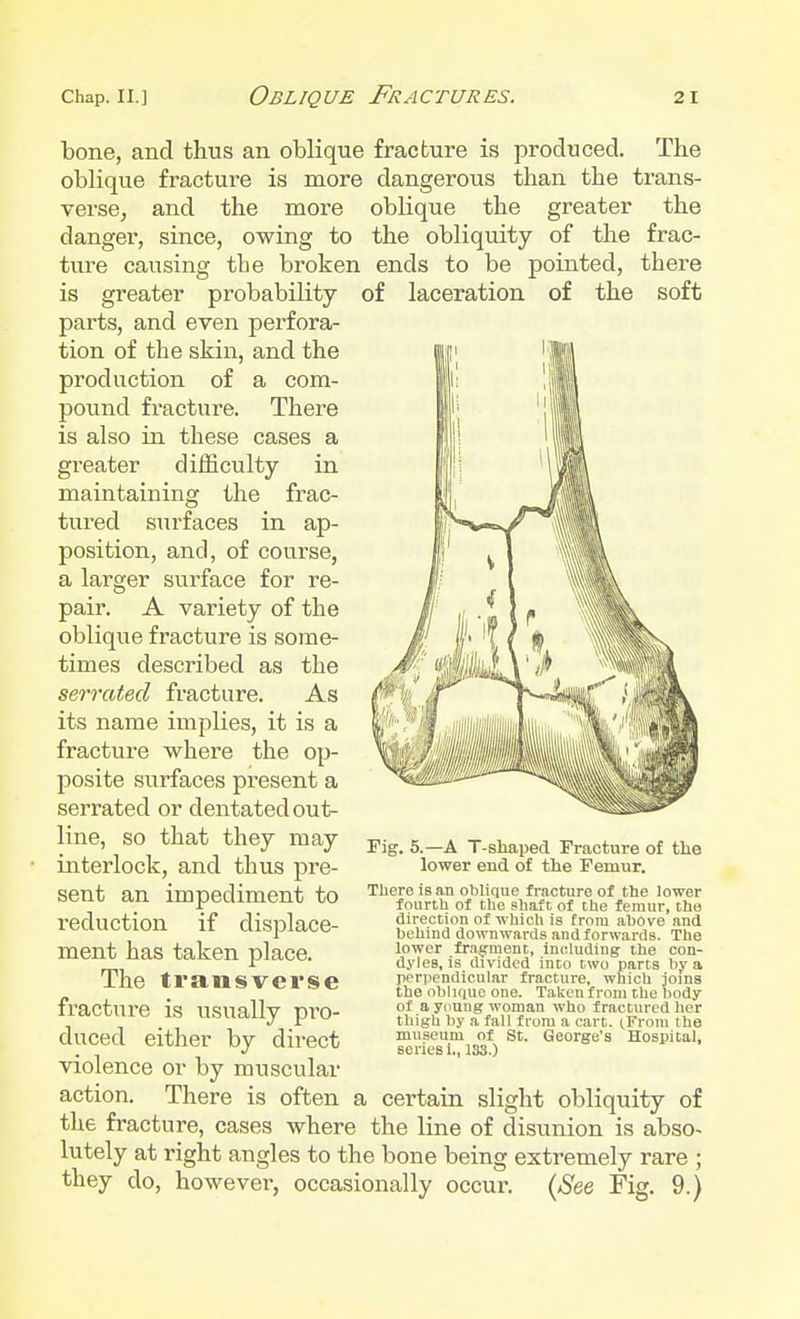bone, and thus an oblique fracture is produced. The oblique fracture is more dangerous than the trans- verse, and the more oblique the greater the dangei*, since, owing to the obliquity of the frac- ture causing the broken ends to be pointed, there is greater probability of laceration of the soft parts, and even perfora- tion of the skin, and the production of a com- pound fracture. There is also in these cases a greater difficulty in maintaining the frac- tured surfaces in ap- position, and, of course, a larger surface for re- pair. A variety of the oblique fracture is some- times described as the serrated fracture. As its name implies, it is a fracture where the op- posite surfaces present a serrated or dentated out- line, so that they may interlock, and thus pre- sent an impediment to reduction if displace- ment has taken place. The transverse fracture is usually pro- duced either by direct violence or by muscular action. There is often a certain slight obliquity of the fracture, cases where the line of disunion is abso- lutely at right angles to the bone being extremely rare ; they do, however, occasionally occur. (See Fig. 9.) Fig. 5.—A T-shaped Fracture of the lower end of the Femur. There is an oblique fracture of the lower fourth of the shaft of the femur, the direction of which is from above and behind downwards and forwards. The lower fragment, including the con- dyles, is divided into two parts by a perpendicular fracture, which joins the oblique one. Taken from the body of a young woman who fractured her thigh by a fall from a cart. cFrom the museum of St. George's Hospital, series i., 133.)