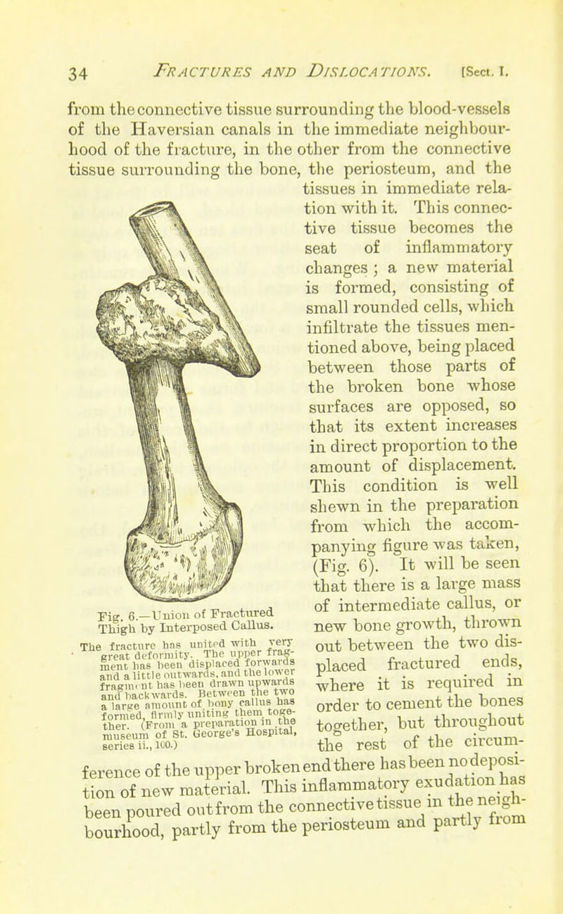 from the connective tissue surrounding the blood-vessels of the Haversian canals in the immediate neighbour- hood of the fracture, in the other from the connective tissue surrounding the bone, the periosteum, and the tissues in immediate rela- tion with it. This connec- tive tissue becomes the seat of inflammatory changes ; a new material is formed, consisting of small rounded cells, which infiltrate the tissues men- tioned above, being placed between those parts of the broken bone whose surfaces are opposed, so that its extent increases in direct proportion to the amount of displacement. This condition is well shewn in the preparation from which the accom- panying figure was taken, (Fig. 6). It will be seen that there is a large mass of intermediate callus, or new bone growth, thrown out between the two dis- placed fractured ends, where it is required in order to cement the bones together, but throughout the rest of the circum- Fig. 6.—Union of Fractured Thigh by Interposed Callus. The fracture has united with very great deformity. The upper fiag- roent lias been displaced forwards and a little outwards, and the lon er fragim nt has been drawn upwards and backwards. Between the two a larae amount of bony callus has formed, firmly uniting them toge- ther. (From a preparation in tne museum of St. George'B Hospital, series ii., KiO.) ference of the upper broken end there hasbeen nodeposi tion of new material. This inflammatory exudation has been poured outfrom the connective tissue m the neigh- bourhood, partly from the periosteum and partly from
