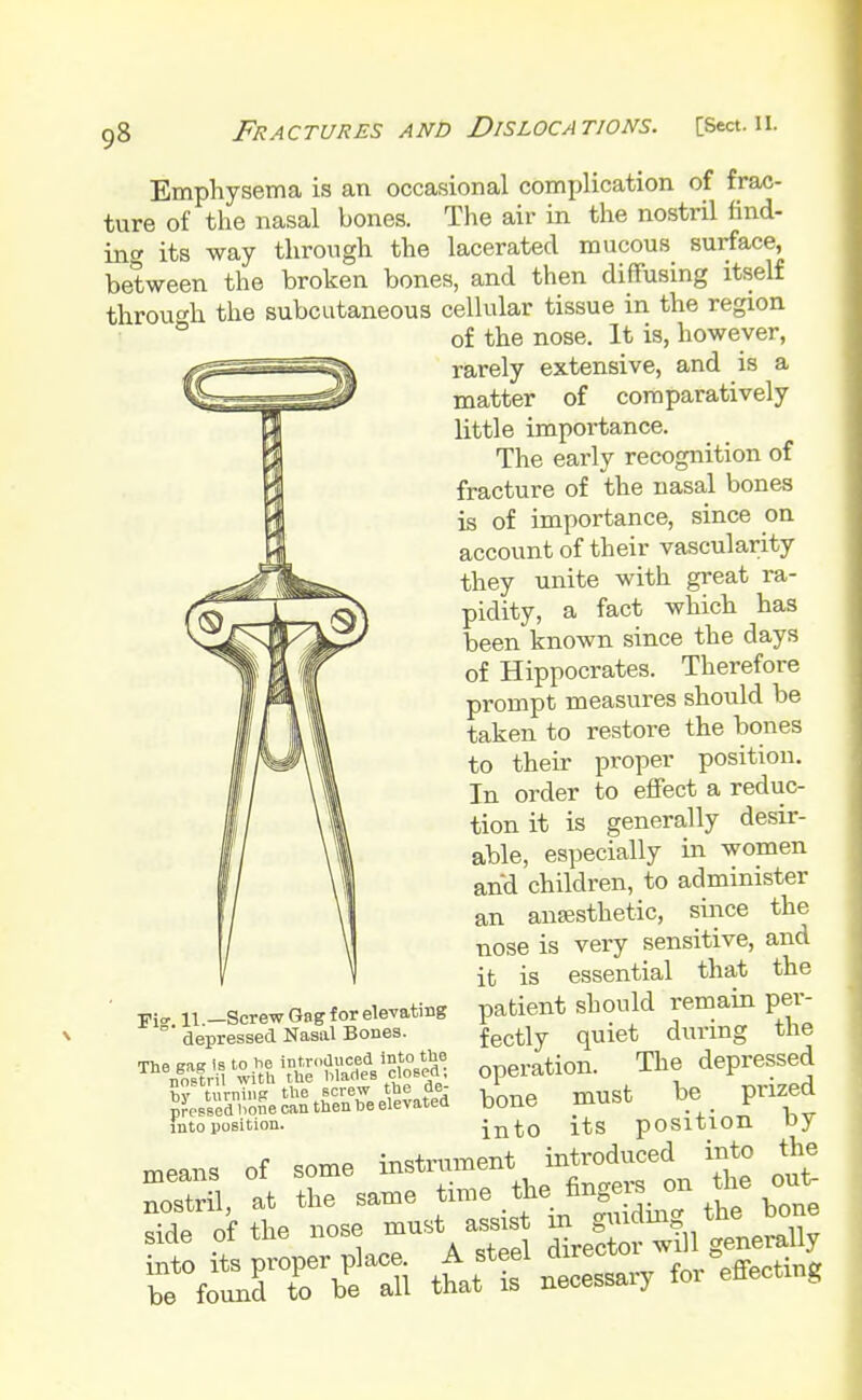 Emphysema is an occasional complication of frac- ture of the nasal bones. The air in the nostril find- ing its way through the lacerated mucous surface, between the broken bones, and then diffusing itself through the subcutaneous cellular tissue in the region of the nose. It is, however, rarely extensive, and is a matter of comparatively little importance. The early recognition of fracture of the nasal bones is of importance, since on account of their vascularity they unite with great ra- pidity, a fact which has been known since the days of Hippocrates. Therefore prompt measures should be taken to restore the bones to their proper position. In order to effect a reduc- tion it is generally desir- able, especially in women and children, to administer an anaesthetic, since the nose is very sensitive, and it is essential that the patient should remain per- fectly quiet during the operation. The depressed bone must be prized into its position by instrument introduced into the Fi<, 11 —Screw Gag for elevating depressed Nasal Bones. The ens is to he introduced into the n'oetril with the Manes closed bv turning the screw the oe- p^essed l'oSe can then be elevated into position. the bone nose riTft t«T necessary for effect^