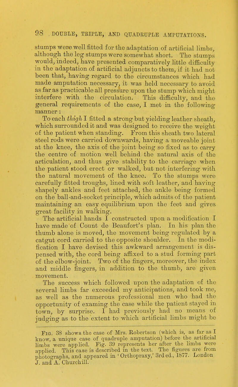 stumps were well fitted for tlie adaptation of artificial limbs, although the leg stumps were somewhat short. The stumps would, indeed, have presented comparatively little difiiculty in the adaptation of artificial adjuncts to them, if it had not been that, having regard to the circumstances which had made amputation necessary, it was held necessary to avoid as far as practicable all pressure upon the stump which might interfere with the circulation. This difiiculty, and the general requirements of the case, I met in the following manner: To each thighl fitted a strong but yielding leather sheath, which surrounded it and was designed to receive the weight of the patient when standing. From this sheath two lateral steel rods were carried downwards, having a moveable joint at the knee, the axis of the joint being so fixed as to carry the centre of motion well behind the natural axis of the ai-ticulation, and thus give stability to the carriage when the patient stood erect or walked, but not interfei'ing with the natural movement of the knee. To the stumps were carefully fitted troughs, lined with soft leather, and having shapely ankles and feet attached, the ankle being formed on the ball-and-socket principle, which admits of the patient maintaining an easy equilibrium upon the feet and gives great facility in walking. The artificial hands I constructed upon a modification I have made of Count de Beaufort's plan. In his plan the thumb alone is moved, the movement being regulated by a catgut cord carried to the opposite shoulder. In the modi- fication I have devised this awkward arrangement is dis- pensed with, the cord being afiixed to a stud forming part of the elbow-joint. Two of the fingers, moreover, the index and middle fingers, in addition to the thumb, are given movement. The success which followed upon the adaptation of the several limbs far exceeded my anticipations, and took me, as well as the numerous professional men who had the opportunity of examing the case while the patient stayed in town, by surprise. I had previously had no meaus of judging as to the extent to which artificial limbs might be Fig. 38 shows the case of Mrs. Robertson (which is, as far as I know, a unique case of quadruple amputation) before the artificial limbs were applied. Fig. 39 represents her after the limbs were applied. This case is described in the text. The figures are from photographs, and appeared in ' Orthopraxy,' 3rd ed., 1877. Loudon J. and A. Churchill.