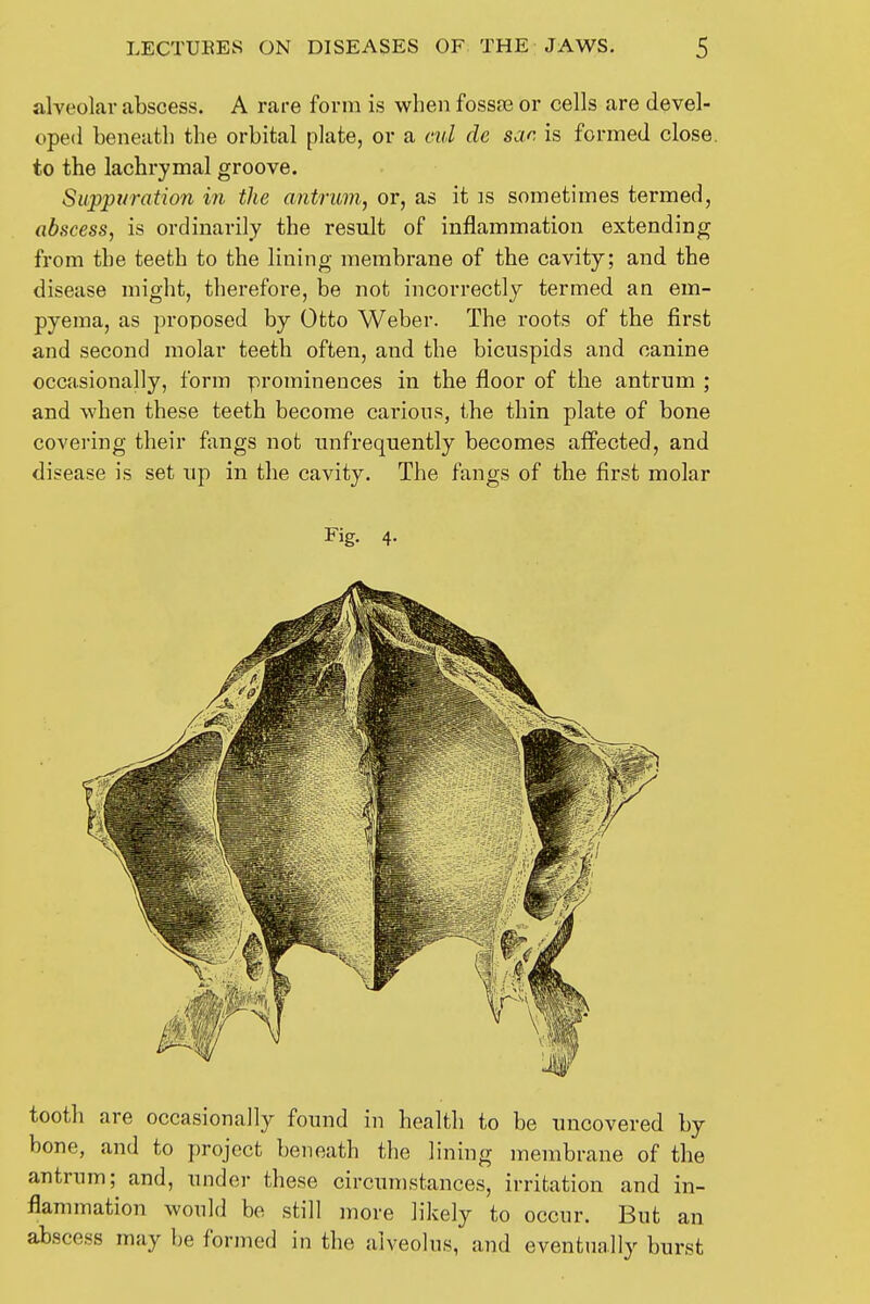 alveolar abscess. A rare form is when fossa3 or cells are devel- oped beneath the orbital plate, or a ml de sar is formed close, to the lachrymal groove. Siippt/ration in the antrum, or, as it ]s sometimes termed, abscess, is ordinarily the result of inflammation extending from the teeth to the lining membrane of the cavity; and the disease might, therefore, be not incorrectly termed an em- pyema, as proposed by Otto Weber. The roots of the first and second molar teeth often, and the bicuspids and canine occasionally, form prominences in the floor of the antrum ; and when these teeth become carious, the thin plate of bone covering their fangs not unfrequently becomes affected, and disease is set up in the cavity. The fangs of the first molar Fig. 4. tooth are occasionally found in health to be uncovered by bone, and to project beneath the lining membrane of the antrum; and, under these circumstances, irritation and in- flammation would be still more likely to occur. But an abscess may be formed in the alveolus, and eventually burst