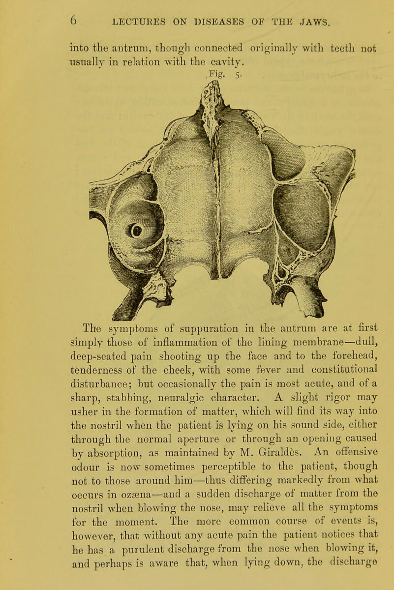 into the antrum, though connected originally with teeth not nsiially in relation with the cavity. Fig. 5- The symptoms of suppuration in the antrum are at first simply those of inflammation of the lining membrane—dull, deep-seated pain shooting up the face and to the forehead, tenderness of the cheek, with some fever and constitutional disturbance; but occasionally the pain is most acute, and of a sharp, stabbing, neuralgic character. A slight rigor may usher in the formation of matter, which will find its way into the nostril when the patient is lying on his sound side, either through the normal aperture or through an opening caused by absorption, as maintained by M. Giraldes. An offensive odour is now sometimes perceptible to the patient, though not to those around him—thus differing markedly from what occurs in ozasna'—and a sudden discharge of matter from the nostril when blowing the nose, may relieve all the symptoms for the moment. The more common course of events is, however, that without any acute pain the patient notices that he has a purulent discharge from the nose when blowing it, and perhaps is aware that, when lying down, the discharge