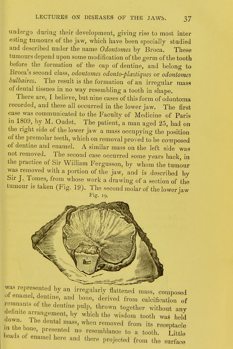 uadergo during their development, giving rise to most inter esting tumours of the jaw, which have been specially studied and described under the name Odontomes by Broca'. These tumours depend upon some modification of the germ of the tooth before the formation of the cap of dentine, and belong to Broca's second class, odontomes odonto-plastiques or odontomes btdbaires. The result is the formation of an irregular mass of dental tissues in no way resembling a tooth in shape. There are, I believe, but nine cases of this form of odontoma recorded, and these all occurred in the lower jaw. The first case was communicated to the Faculty of Medicine of Paris in 1809, by M. Oudet. The patient, a man aged 25, had on the right side of the lower jaw a mass occupying the position of the premolar teeth, which on removal proved to be composed of dentine and enamel. A similar mass on the left side was not removed. The second case occurred some years back, in the practice of Sir William Fergusson, by whom the tumour was removed with a portion of the jaw, and is .described by Sir J. Tomes, from whose work a drawing of a section of the tumour IS taken (Fig. 19). The second molar of the lower jaw Fig. 19. was represented by an irregularly flattened mass, composed of enamel, dentme, and bone, derived from ealcifioation of remnants of the dentine pulp, thrown together withont any definite arrangement, by which the wisdom tooth waS held down. The dental mass, when removed from its receptacle m the bone, presented no resemblance to a tooth. iS bead, of enan,el here and there projected from the surf^e