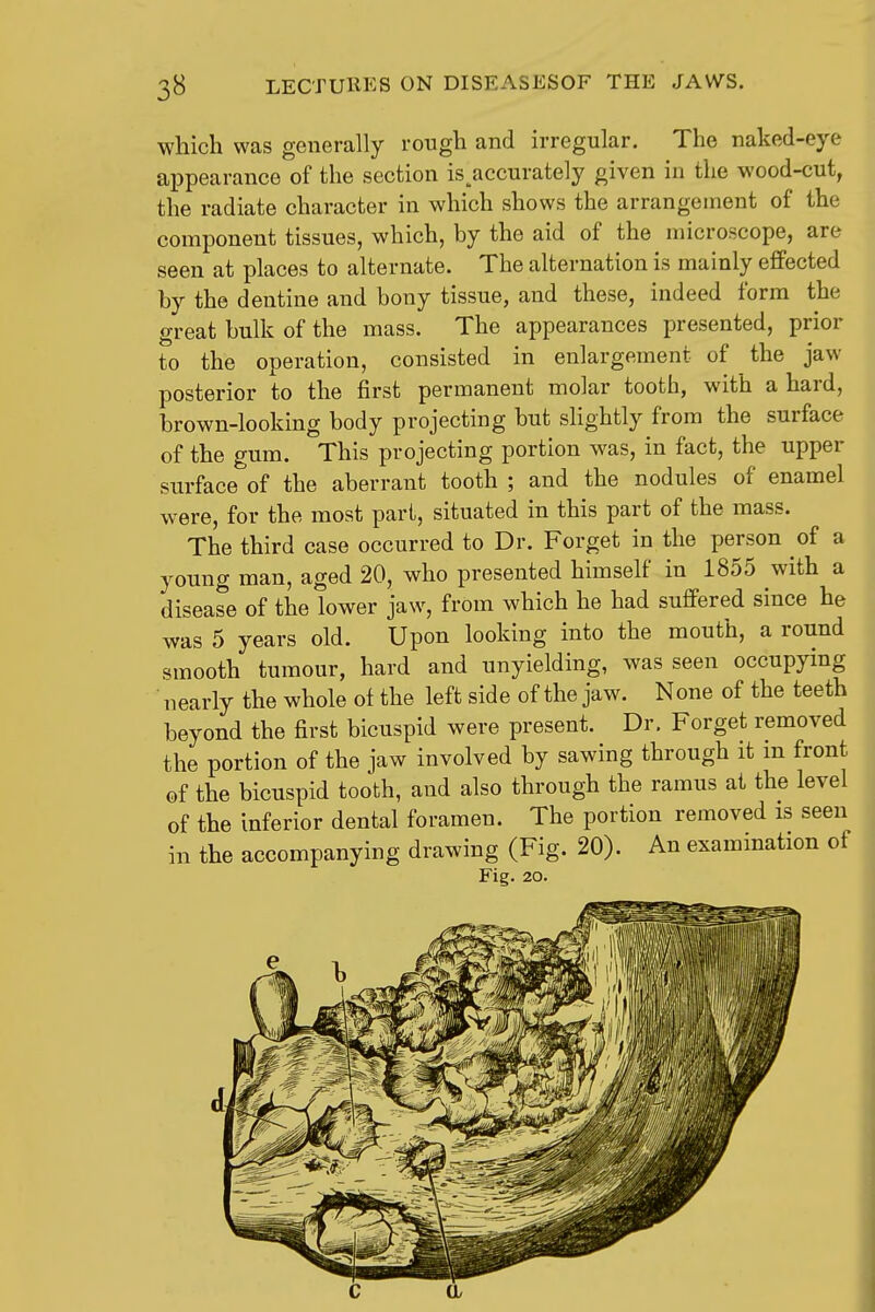 which was generally rough and irregular. The naked-eye appearance of the section is accurately given in the wood-cut, the radiate character in which shows the arrangement of the component tissues, which, by the aid of the microscope, are seen at places to alternate. The alternation is mainly effected by the dentine and bony tissue, and these, indeed form the great bulk of the mass. The appearances presented, prior to the operation, consisted in enlargement of the jaw posterior to the first permanent molar tooth, with a hard, brown-looking body projecting but slightly from the surface of the gum. This projecting portion was, in fact, the upper surface of the aberrant tooth ; and the nodules of enamel were, for the most part, situated in this part of the mass. The third case occurred to Dr. Forget in the person of a young man, aged 20, who presented himself in 1855 with a disease of the lower jaw, from which he had suffered since he was 5 years old. Upon looking into the mouth, a round smooth tumour, hard and unyielding, was seen occupying nearly the whole ot the left side of the jaw. None of the teeth beyond the first bicuspid were present. Dr. Forget removed the portion of the jaw involved by sawing through it m front of the bicuspid tooth, and also through the ramus at the level of the inferior dental foramen. The portion removed is seen in the accompanying drawing (Fig. 20). An examination of Fig. 20. Si