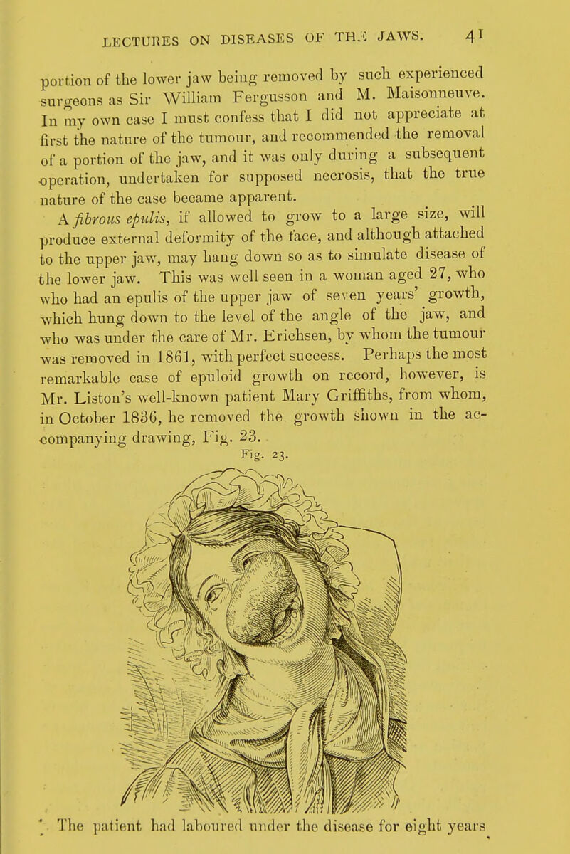 portion of the lower jaw being removed by sucli experienced surcreons as Sir William Fergusson and M. Maisonneuve. In my own case I must confess that I did not appreciate at first the nature of the tumour, and recommended the removal of a portion of the jaw, and it was only during a subsequent operation, undertaken for supposed necrosis, that the true nature of the case became apparent. A fibrous epulis, if allowed to grow to a large size, will produce external deformity of the face, and although attached to the upper jaw, may hang down so as to simulate disease of the lower jaw. This was well seen in a woman aged 27, who who had an epulis of the upper jaw of seven years' growth, which hung down to the level of the angle of the jaw, and who was under the care of Mr. Erichseu, by whom the tumour was removed in 1861, with perfect success. Perhaps the most remarkable case of epuloid growth on record, however, is Mr. Listen's well-known patient Mary Griffiths, from whom, in October 1836, he removed the growth shown in the ac- companying drawing. Fig. 23. Fig. 23. *. The patient had laboured under the disease for eight years