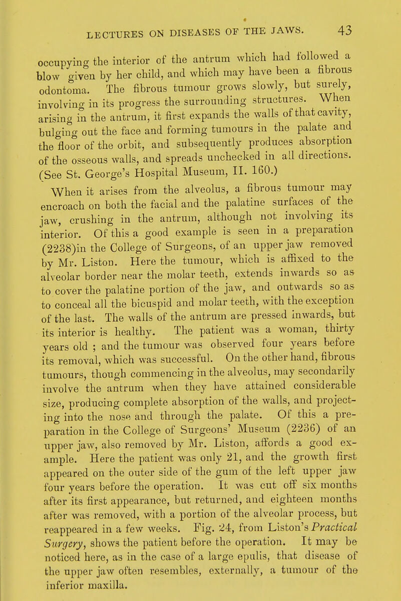 occupyino- the interior of the antrum which had followed a blow given by her child, and which may have been a fibrous odontoma. The fibrous tumour grows slowly, but surely, involving in its progress the surrounding structures. When arising in the antrum, it first expands the walls of that cavity, bulging out the face and forming tumours in the palate and the floor of the orbit, and subsequently produces absorption of the osseous walls, and spreads unchecked in all directions. (See St. George's Hospital Museum, II. 160.) When it arises from the alveolus, a fibrous tumour may encroach on both the facial and the palatine surfaces of the jaw, crushing in the antrum, although not involving its interior. Of this a good example is seen in a preparation (2238)in the College of Surgeons, of an upper jaw removed by Mr. Listen. Here the tumour, which is affixed to the alveolar border near the molar teeth, extends inwards so as to cover the palatine portion of the jaw, and outwards so as to conceal all the bicuspid and molar teeth, with the exception of the last. The walls of the antrum are pressed inwards, but its interior is healthy. The patient was a woman, thirty years old ; and the tumour was observed four years before its removal, which was successful. On the other hand, fibrous tumours, though commencing in the alveolus, may secondarily involve the antrum when they have attained considerable size, producing complete absorption of the walls, and project- ing into the nose and through the palate. Of this a pre- paration in the College of Surgeons' Museum (2236) of an upper jaw, also removed by Mr. Listen, affords a good ex- ample. Here the patient was only 21, and the growth first appeared on the outer side of the gum of the left upper jaw four years before the operation. It was cut olf six months after its first appearance, but returned, and eighteen months after was removed, with a portion of the alveolar process, but reappeared in a few weeks. Fig. 24, from Listen's Practical Surgery, shows the patient before the operation. It may be noticed here, as in the case of a large epulis, that disease of the upper jaw often resembles, externally, a tumour of the inferior maxilla.