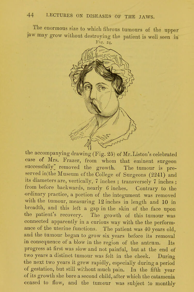 The enormous size to which fibrous tumours of the upper jaw may grow without destroying the patient is well seen in Fie. 24. the accompanying drawing (Fig. 25) of Mr. Listen's celebrated case of Mrs. Frazer, from whom that eminent surgeon successfully' removed the growth. The tumour is pre- served in;the Museum of the College of Surgeons (2241) and its diameters are, vertically, 7 inches ; transversely 7 inches ; from before backwards, nearly 6 inches. Contrary to the ordinary practice, a portion of the integument was removed with the tumour, measuring 12 inches in length and 10 in breadth, and this left a gap in the skin of the face upon the patient's recovery. The growth of this tumour was connected apparently in a curious way with the the perform- ance of the uterine functions. The patient was 40 years old, and the tumour began to grow six years before its removal in consequence of a blow in the region of the antrum. Its progress at first was slow and not painful, but at the end of two years a distinct tumour was felt in the cheek. During the next two years it grew rapidly, especially during a period of gestation, but still without much pain. In the fifth year of its growth she bore a second child, after which the catamenia ceased to flow, and the tumour was subject io monthly