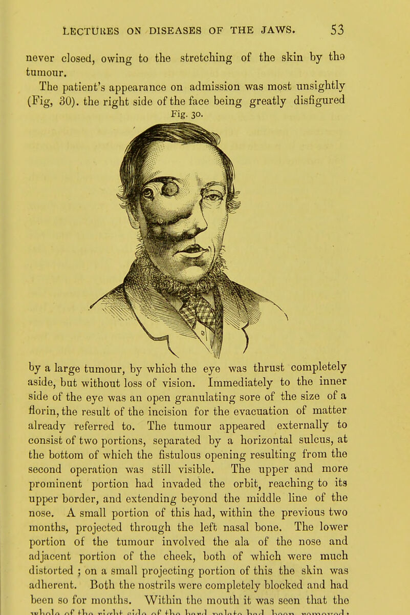 never closed, owing to the stretching of the skin by tho tumour. The patient's appearance on admission was most unsightly (Fig, 30). the right side of the face being greatly disfigured Fig. 30. by a large tumour, by which the eye was thrust completely aside, but without loss of vision. Immediately to the inner side of the eye was an open granulating sore of the size of a florin, the result of the incision for the evacuation of matter already referred to. The tumour appeared externally to consist of two portions, separated by a horizontal sulcus, at the bottom of which the fistulous opening resulting from the second operation was still visible. The upper and more prominent portion had invaded the orbit, reaching to its upper border, and extending beyond the middle line of the nose. A small portion of this had, within the previous two months, projected through the left nasal bone. The lower portion of the tumour involved the ala of the nose and adjacent portion of the cheek, both of which were much distorted ; on a small projecting portion of this the skin was adherent. Both the nostrils were completely blocked and had been so for months. Within the mouth it was seen that the