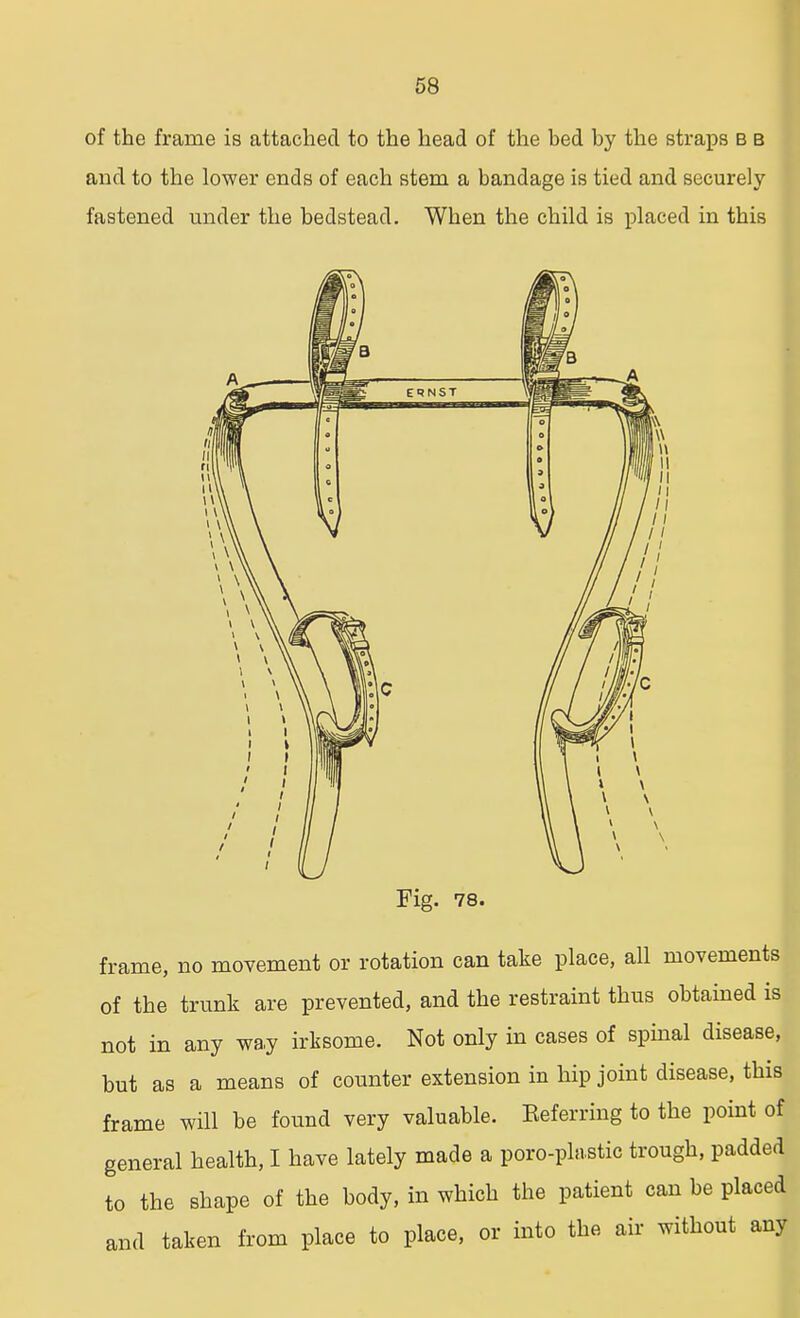 of the frame is attached to the head of the bed by the straps b b and to the lower ends of each stem a bandage is tied and securely fastened under the bedstead. When the child is placed in this Fig. 78. frame, no movement or rotation can take place, all movements of the trunk are prevented, and the restraint thus obtained is not in any way irksome. Not only in cases of spinal disease, but as a means of counter extension in hip joint disease, this frame will be found very valuable. Referring to the point of general health, I have lately made a poro-plastic trough, padded to the shape of the body, in which the patient can be placed and taken from place to place, or into the air without any