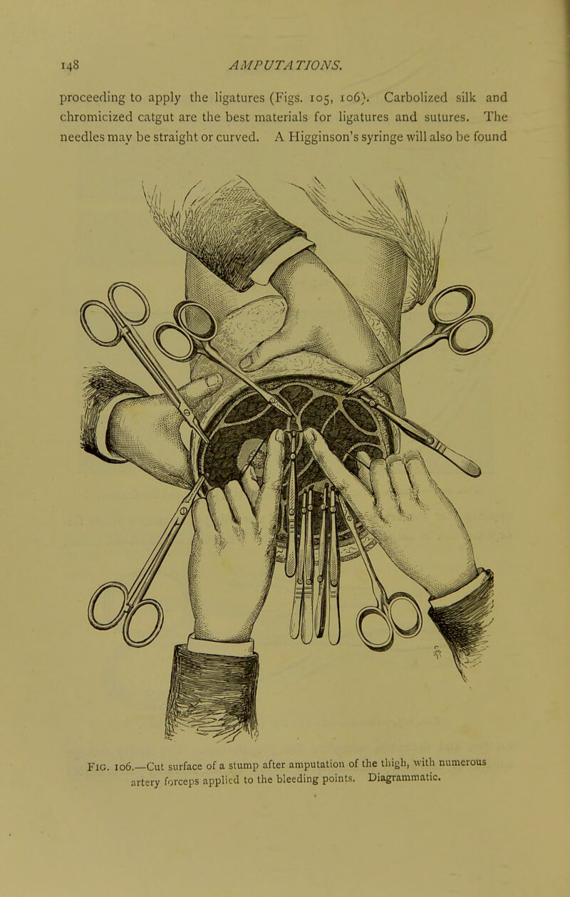 proceeding to apply the ligatures (Figs. 105, 106}. Carbolized silk and chromicized catgut are the best materials for ligatures and sutures. The needles may be straight or curved. A Higginson's syringe will also be found Fig. 106.—Cut surface of a slump after amputation of the lliigb, with numerous artery forceps applied to the bleeding points. Diagrammatic.