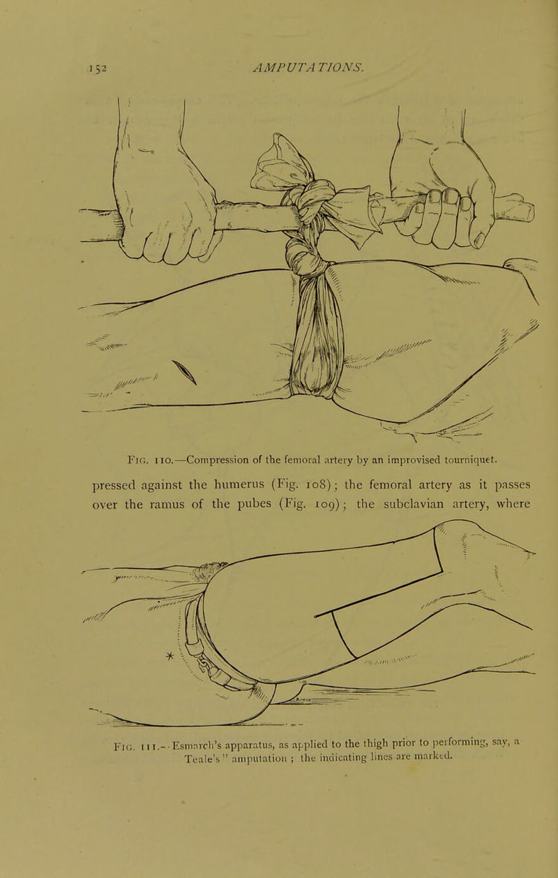 ] 52 A MP UTA TIONS. Fig. no.—Compression of the femoral artery by an improvised tourniquet. pressed against the hutnerus (Fig. io8); the femoral artery as it passes over the ramus of the pubes (Fig. 109); the subclavian artery, where Fic. iii.- Esninvcli's apparatu.s, as applied to the thigh prior to performing, say, a Teale's ampulalion ; the indicating lines are marked.