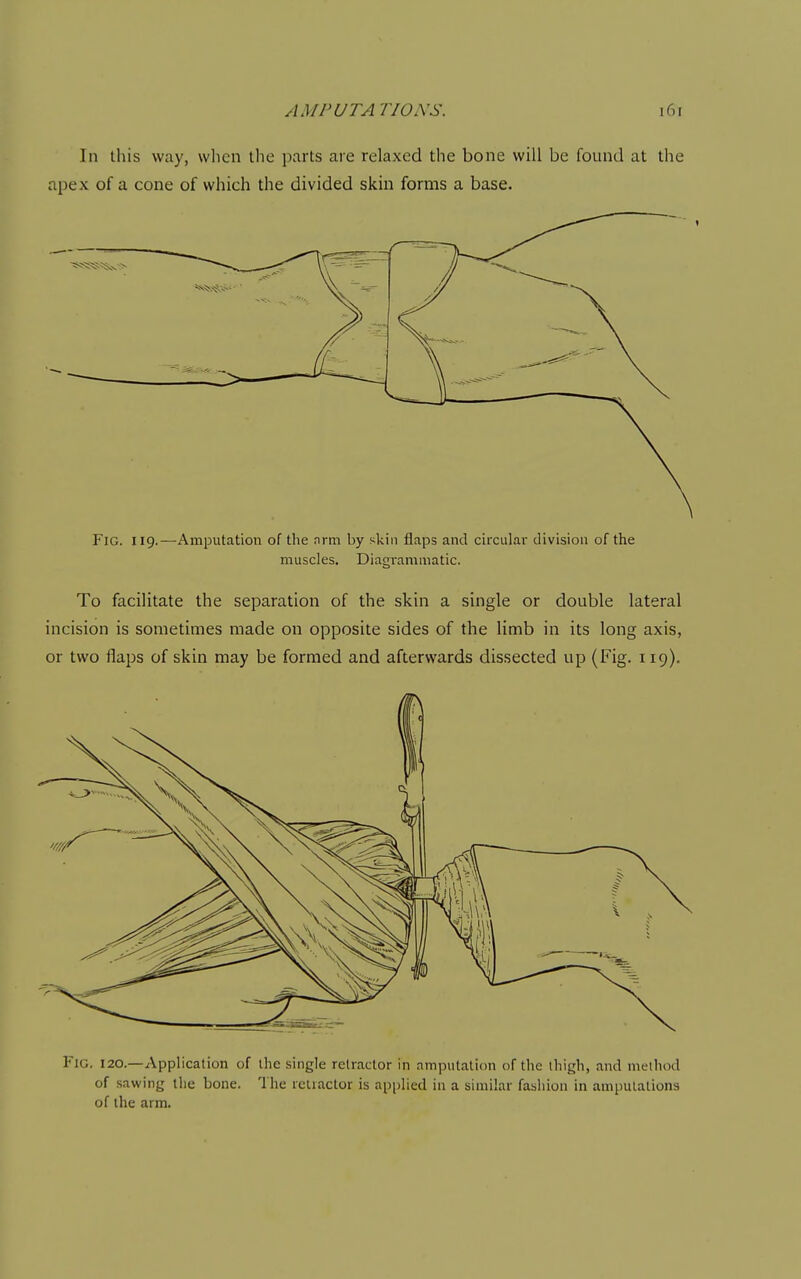 In this way, when the parts are relaxed the bone will be found at the apex of a cone of which the divided skin forms a base. Fig. 119.—Amputation of the nrm by skin flaps and circular division of the muscles. Diagrammatic. To facilitate the separation of the skin a single or double lateral incision is sometimes made on opposite sides of the limb in its long axis, or two flaps of skin may be formed and afterwards dissected up (Fig. 119). Fig. 120.—Application of the single retractor in amputati(m of the thigh, and method of sawing the bone. The rcliactor is applied in a similar fashion in amputations of the arm.