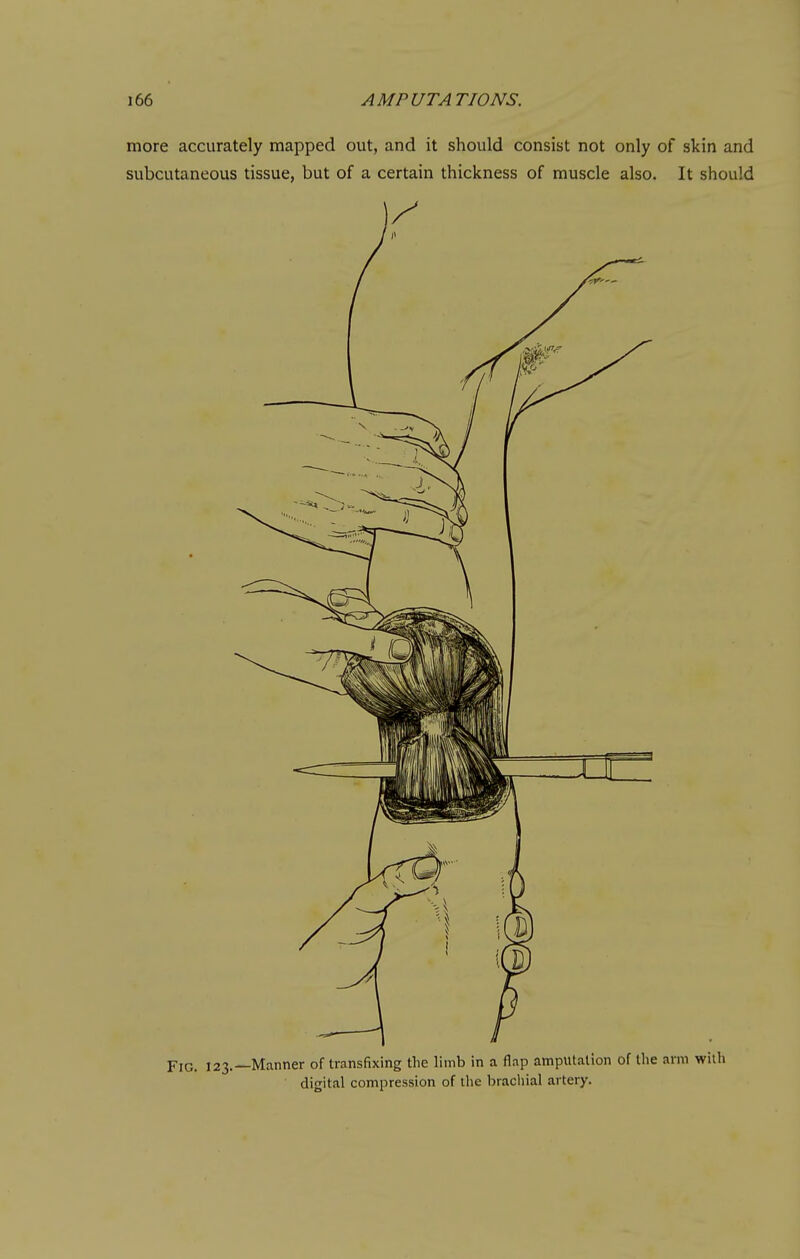 more accurately mapped out, and it should consist not only of skin and subcutaneous tissue, but of a certain thickness of muscle also. It should Fig. 123.—Manner of transfixing the limb in a flap amputation of the arm with digital compression of the bracliial artery.