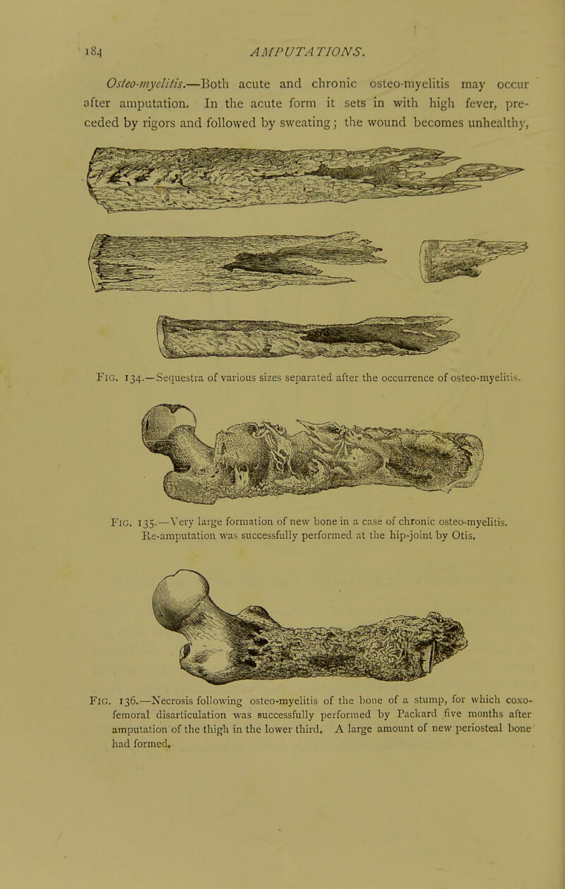 f AMPUTATIONS. Osieo-myelitis.—Both acute and chronic osteomyelitis may occur after amputation. In the acute form it sets in with high fever, pre- ceded by rigors and followed by sweating; the wound becomes unhealthy, Fig. 134.—Sequestra of various sizes separated after the occurrence of osteo-myelitis. Fig. 135.—Very large formation of new bone in a case of chronic osteo-myelitis. Re-amputation was successfully performed at the hip-joint by Otis. Fig. 136.—Necrosis following osteo-myelitis of the bone of a stump, for which coxo- femoral disarticulation was successfully performed by Packard five months after amputation of the thigh in the lower third. A large amount of new periosteal bone had formed.