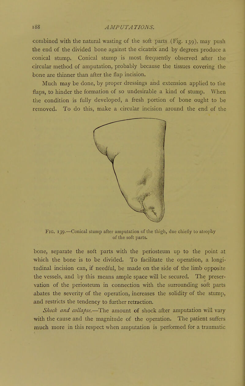 combined with the natural wasting of the soft parts (Fig. 139), may push the end of the divided bone against the cicatrix and by degrees produce a conical stump. Conical stump is most frequently observed after the circular method of amputation, probably because the tissues covering the bone are thinner than after the flap incision. Much may be done, by proper dressings and extension applied to the flaps, to hinder the formation of so undesirable a kind of stump. When the condition is fully developed, a fresh portion of bone ought to be removed. To do this, make a circular incision around the end of the Fig. 139.—Conical stump after amputation of the thigh, due chiefly to atrophy of the soft parts. iDone, separate the soft parts with the periosteum up to the point at which the bone is to be divided. To facilitate the operation, a longi- tudinal incision can, if needful, be made on the side of the limb opposite the vessels, and by this means ample space will be secured. The preser- vation of the periosteum in connection with the surrounding soft parts abates the severity of the operation, increases the solidity of the stump, and restricts the tendency to further retraction. Shock and collapse.—The amount of shock after amputation will vary with the cause and the magnitude of the operation. The patient suffers much more in this respect when amputation is performed for a traumatic