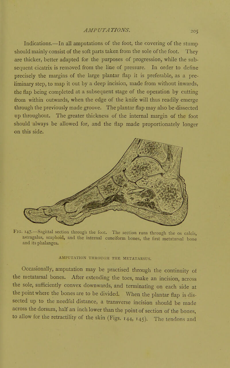 Indications.—In all amputations of the foot, the covering of the stump should mainly consist of the soft parts taken from the sole of the foot. They are thicker, better adapted for the purposes of progression, while the sub- sequent cicatrix is removed from the line of pressure. In order to define precisely the margins of the large plantar flap it is preferable, as a pre- liminary step, to map it out by a deep incision, made from without inwards, the flap being completed at a subsequent stage of the operation by cutting from within outwards, when the edge of the knife will thus readily emerge through the previously made groove. The plantar flap may also be dissected up throughout. The greater thickness of the internal margin of the foot should always be allowed for, and the flap made proportionately longer on this side. Fig. 147.—Sagittal section througli the foot. The section runs through tlie os calcis, astragalus, scaphoid, and the internal cuneiform bones, the first metatarsal Ijone and its phalanges. AMPUTATION THKOUCII THE METATARSUS. Occasionally, amputation may be practised through the continuity of the metatarsal bones. After extending the toes, make an incision, across the sole, sufficiently convex downwards, and terminating on each side at the point where the bones are to be divided. When the plantar flap is dis- sected up to the needftil distance, a transverse incision should be made across the dorsum, half an inch lower than the point of section of the bones, to allow for the retractility of the skin (Figs. 144, 145). The tendons and