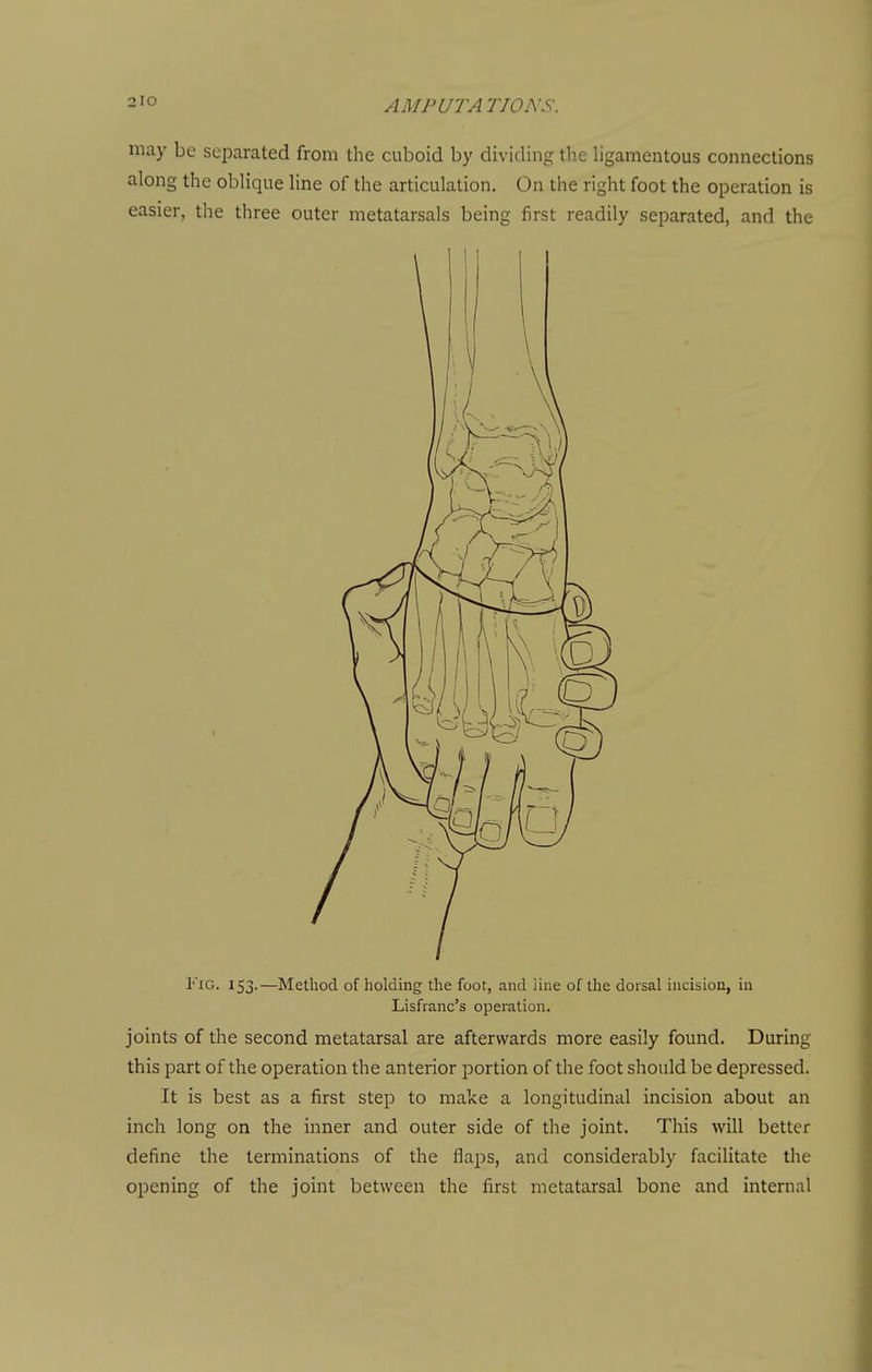 may be separated from the cuboid by dividing tlie ligamentous connections along the oblique line of the articulation. On the right foot the operation is easier, the three outer metatarsals being first readily separated, and the Fig. 153.—Method of holding the foot, and line of the dorsal incision, in Lisfianc's operation. joints of the second metatarsal are afterwards more easily found. During this part of the operation the anterior portion of the foot should be depressed. It is best as a first step to make a longitudinal incision about an inch long on the inner and outer side of the joint. This will better define the terminations of the flaps, and considerably facilitate the opening of the joint between the first metatarsal bone and internal