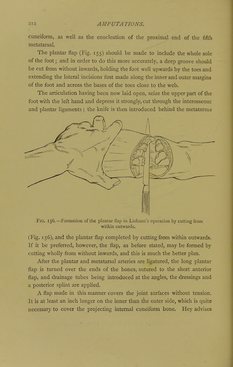 cuneiform, as well as the enucleation of the proximal end of the fifth metatarsal. The plantar flap (Fig. 155) should be made to include the whole sole of the foot; and in order to do this more accurately, a deep groove should be cut from without inwards, holding the foot well upwards by the toes and extending the lateral incisions first made along the inner and outer margins of the foot and across the bases of the toes close to the web. The articulation having been now laid open, seize the upper part of the foot with the left hand and depress it strongly, cut through the interosseous and plantar ligaments ; the knife is then introduced behind the metatarsus Fig. 156.—Formation of the plantar flap in Lisfranc's operation by cutting from within outwards. (Fig. 156), and the plantar flap completed by cutting from within outwards. If it be preferred, however, the flap, as before stated, may be formed by cutting wholly from without inwards, and this is much the better plan. After the plantar and metatarsal arteries are ligatured, the long plantar flap is turned over the ends of the bones, sutured to the short anterior flap, and drainage tubes being introduced at the angles, the dressings and a posterior splint are applied. A flap made in this, manner covers the joint surfaces without tension. It is at least an inch longer on the inner than the outer side, which is quite necessary to cover the projecting internal cuneiform bone. Hey advises-