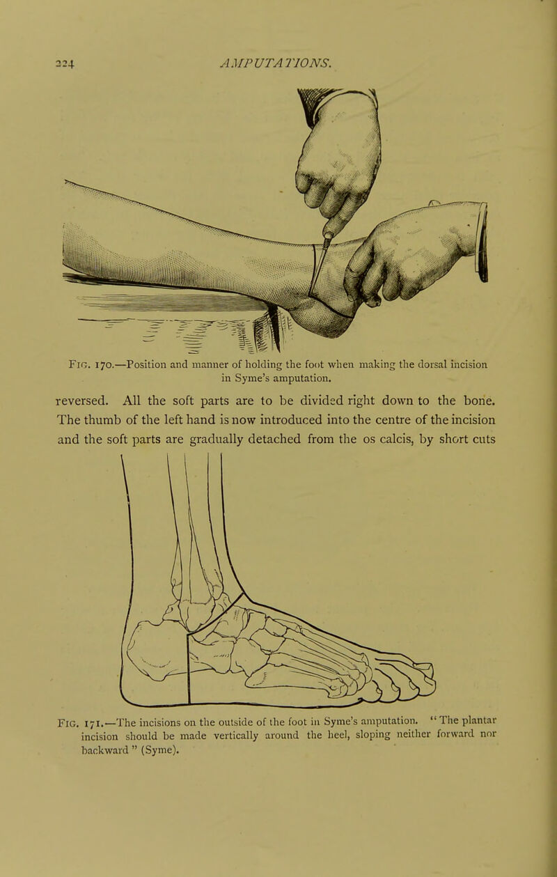 Fig. 170.—Position and manner of holding the foot when making the dorsal incision in Syme's amputation. reversed. All the soft parts are to be divided right down to the bone. The thumb of the left hand is now introduced into the centre of the incision and the soft parts are gradually detached from the os calcis, by short cuts Fig. 171.—The incisions on the outside of the foot in Syme's amputation.  The plantar incision should be made vertically around the heel, sloping neither forward nor backward  (Syme).