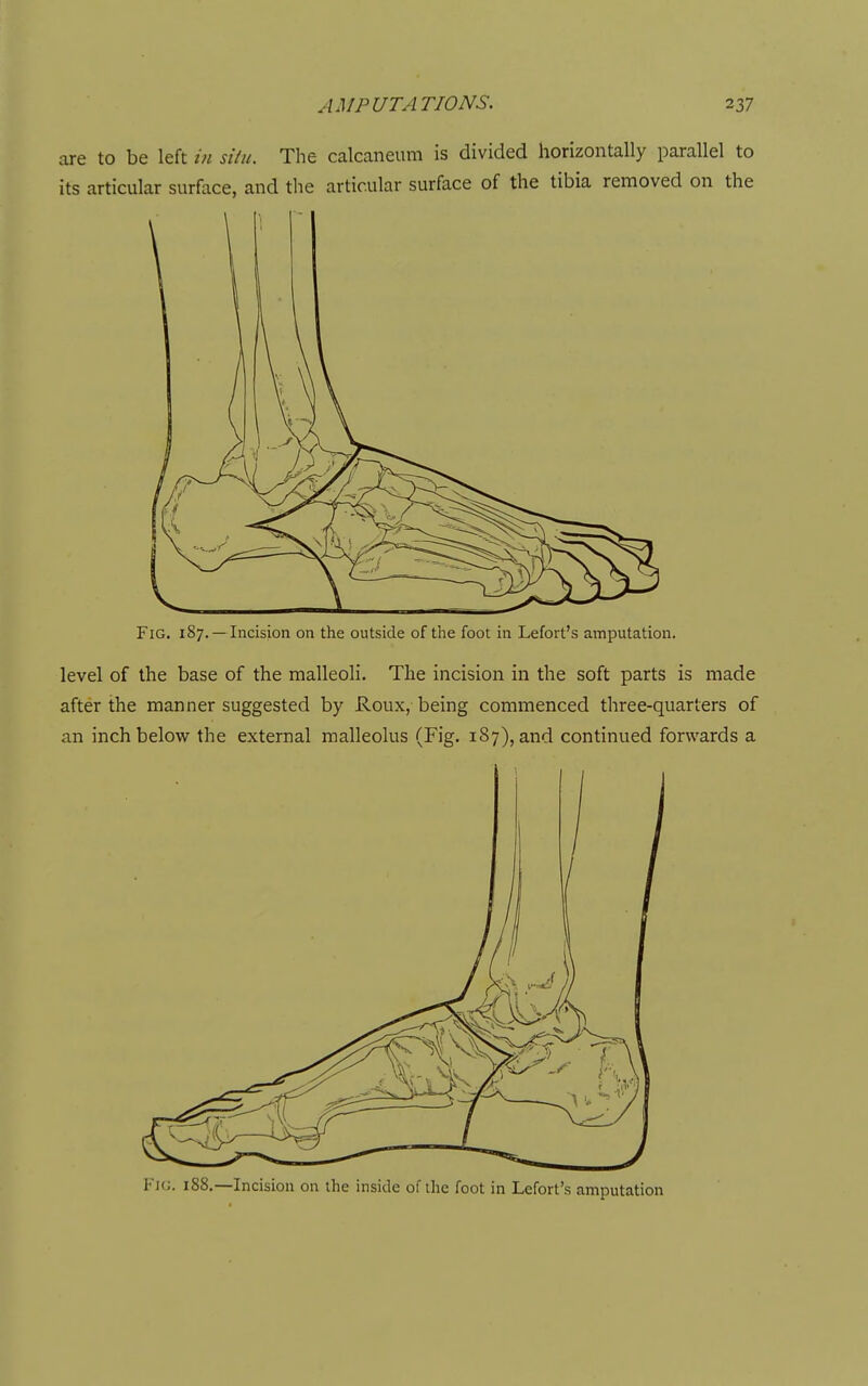 Fig. 187.— Incision on the outside of the foot in Lefort's amputation. level of the base of the malleoli. The incision in the soft parts is made after the manner suggested by Roux, being commenced three-quarters of an inch below the external malleolus (Fig. 1S7), and continued forwards a Fkj. 188.—Incision on the inside of the foot in Lefort's amputation