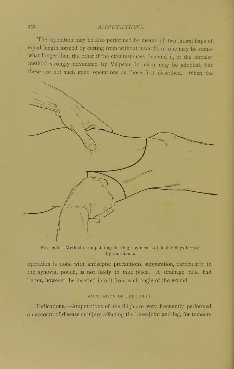 The operation may be also performed by means of two lateral flaps of equal length formed by cutting from without inwards, or one may be some- what longer than tlie other if the circumstances demand it, or the circular method strongly advocated by Velpeau, in 1S29, may be adopted, but these are not such good operations as those first described. When the Fig. 206.—Method of amputating tlie thigh by means of double flaps formed by transfixion. operation is done with antiseptic precautions, suppuration, particularly in the synovial pouch, is not likely to take place. A drainage tube had better, however, be inserted into it from each angle of the wound. AMPUTATION OF THE THIGH. Indications.—Amputations of the thigh are very frequently performed on account of disease or injury affecting the knee-joint and leg, for tumours