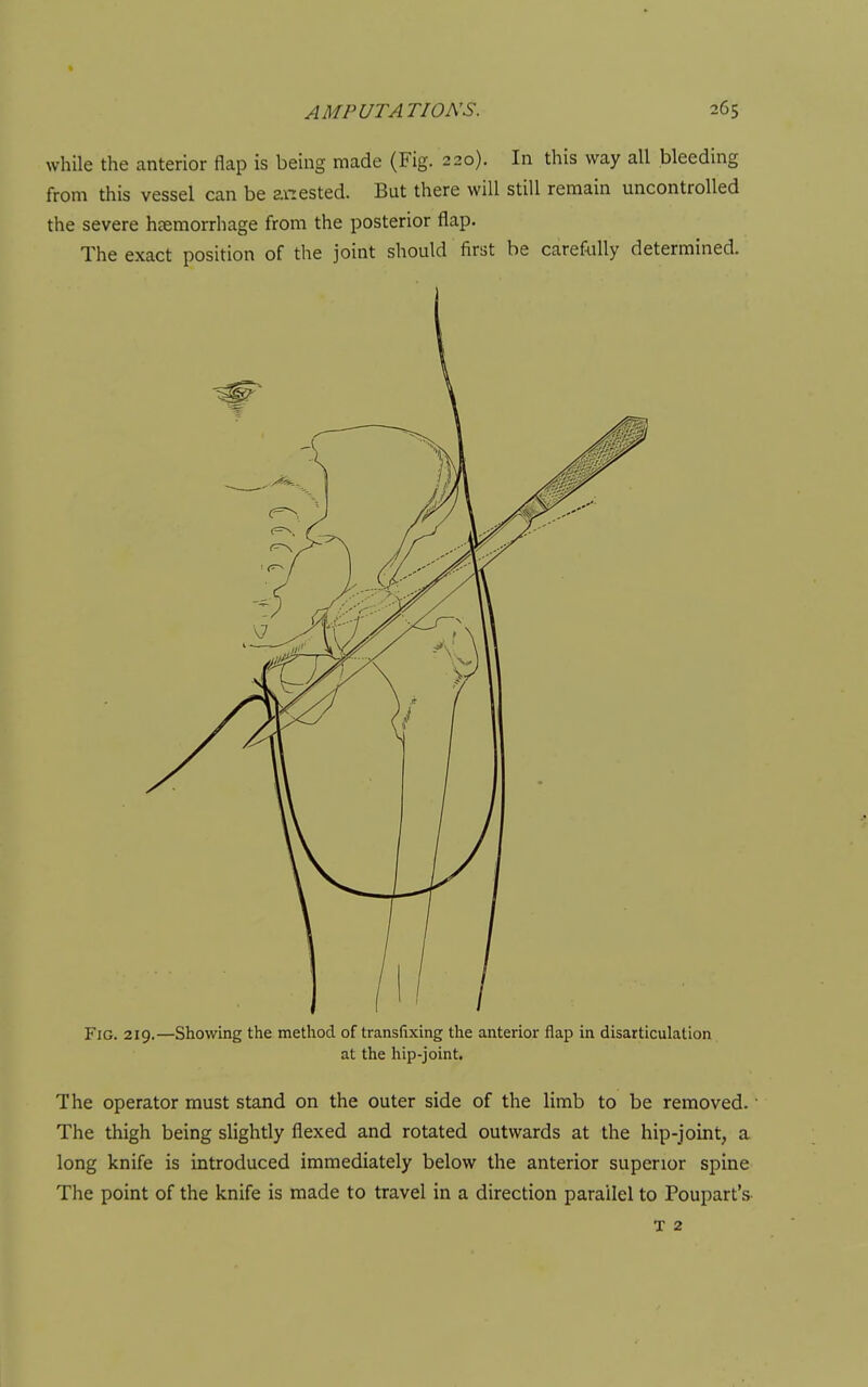 while the anterior flap is being made (Fig. 220). In this way all bleeding from this vessel can be anested. But there will still remain uncontrolled the severe hsemorrhage from the posterior flap. The exact position of the joint should first be caref<illy determined. Fig. 219.—Showing the method of transfixing the anterior flap in disarticulation at the hip-joint. The operator must stand on the outer side of the limb to be removed. The thigh being slightly flexed and rotated outwards at the hip-joint, a long knife is introduced immediately below the anterior superior spine The point of the knife is made to travel in a direction parallel to Poupart's