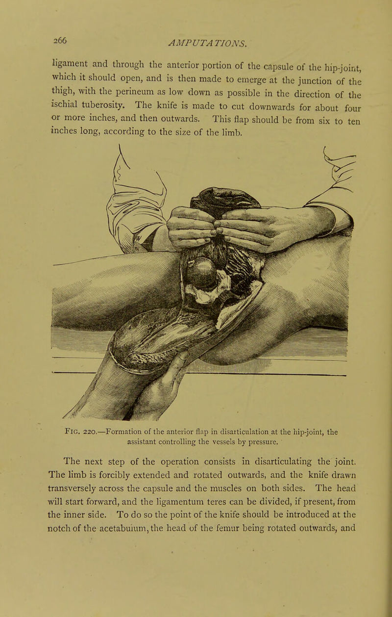 ligament and through the anterior portion of the capsule of the hip-joint, which it should open, and is then made to emerge at the junction of the thigh, with the perineum as low down as possible in the direction of the ischial tuberosity. The knife is made to cut downwards for about four or more inches, and then outwards. This flap should be from six to ten inches long, according to the size of the limb. Fig. 220.—Formation of the anterior flap in disarticulation at the hip-joint, the assistant controlling the vessels by pressure. The next step of the operation consists in disarticulating the joint. The limb is forcibly extended and rotated outwards, and the knife drawn transversely across the capsule and the muscles on both sides. The head will start forward, and the ligamentum teres can be divided, if present, from the inner side. To do so the point of the knife should be introduced at the notch of the acetabulum, the head of the femur being rotated outwards, and