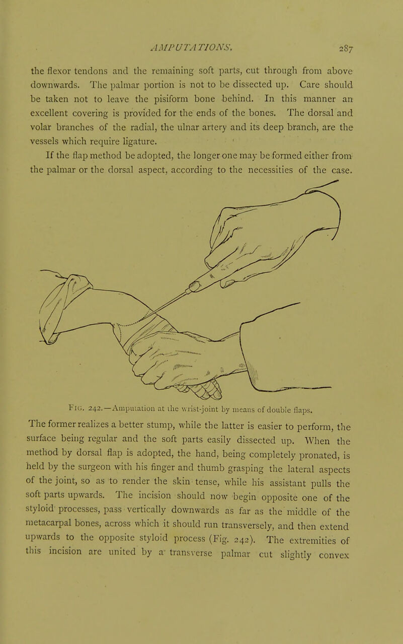 the flexor tendons and the remaining soft parts, cut through from above downwards. The pahnar portion is not to be dissected up. Care should be taken not to leave the pisiform bone behind. In this manner an excellent covering is provided for the ends of the bones. The dorsal and volar branches of the radial, the ulnar artery and its deep branch, are the vessels which require ligature. If the flap method be adopted, the longer one may be formed either from the palmar or the dorsal aspect, according to the necessities of the case. Fu;. 242.—Ampuialion at ihe wrist-joint by means of double flaps. The former realizes a better stump, while the latter is easier to perform, the surface being regular and the soft parts easily dissected up. When the method by dorsal flap is adopted, the hand, being completely pronated, is held by the surgeon with his finger and thumb grasping the lateral aspects of the joint, so as to render the skin tense, while his assistant pulls the soft parts upwards. The incision should now begin opposite one of the styloid'processes, pass vertically downwards as far as the middle of the metacarpal bones, across which it should run transversely, and then extend upwards to the opposite styloid process (Fig. 242). The extremities of this incision are united by a- transverse palmar cut slightly convex