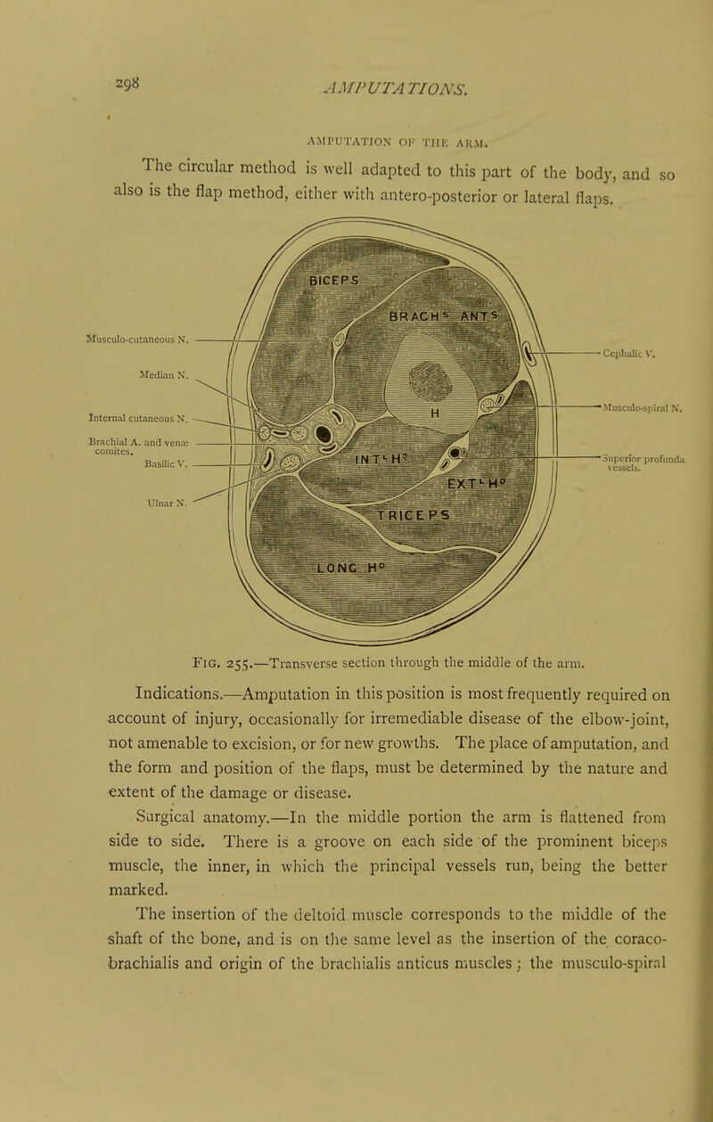 AMPUTATION OF THE ARM. The circular method is well adapted to this part of the body, and s also IS the flap method, either with antero-posterior or lateral flaps. Musculo-cutaneous N. Median N. Internal cutaneous N'. Brachial A. and vena; comites. Basilic V. Ulnar N. Cephalic \'. Musculo-suiral N. Superior profunda vessels. Fig. 25.15.—Transverse section through the middle of the arm. Indications.—Amputation in this position is most frequently required on account of injury, occasionally for irremediable disease of the elbow-joint, not amenable to excision, or for new growths. The place of amputation, and the form and position of the flaps, must be determined by the nature and -extent of the damage or disease. Surgical anatomy.—In the middle portion the arm is flattened from side to side. There is a groove on each side of the prominent biceps muscle, the inner, in which the principal vessels run, being the better marked. The insertion of the deltoid muscle corresponds to the middle of the shaft of the bone, and is on the same level as the insertion of the coraco- brachialis and origin of the brachialis anticus muscles; the musculo-spiral