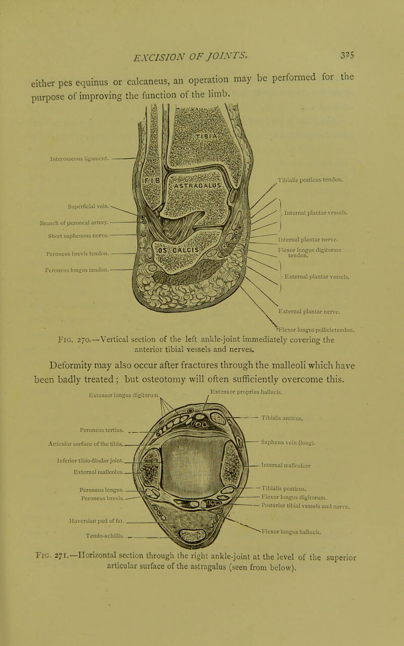 either pes equinus or calcaneus, an operation may be performed for tlie purpose of improving the function of the limb. Interosseous lii^.uucnt, Superficial vein. Brancli of peroneal artery. Short saplienous nen e. Teroneus brevis tendon. Peroneus longns tendon. Tibialis posticus tendon. Internal plantar \ essels. Internal plantar nerve. Flexor longu.s digitoruiu teitdon. E.\ternal plantar vessels. E.Kternal plantar nerve. Flexor long^spollicistendon. ^Mexor longi Fig. 270.—Vertical section of the left ankle-joint immediately covering the anterior tibial vessels and nerves. Deformity may also occur after fractures through the malleoli which have been badly treated; but osteotomy will often sufficiently overcome this. Extensor proprius liallucis. E.-ctensor loiigus digitorum. I'eronens tertius. Articular surface of the tibia. ) nferior tibio-fibular joint. E.vternal nialleohis. Peroneus longus. Peroneus brevis Haversian pad of fat, Tcndo-acliillis. Tibialis anticus. Saphcna vein (loni,'). Internal nialloolu.';r — Tibialis posticus. I'lexor lonfjus difiitoruni. Posterior tibial vessels and nerve. I-lexor loni;us hallucis. Fig. 271.—Horizontal section through the right ankle-joint at the level of the superior articular surface of the astragalus (seen from below).