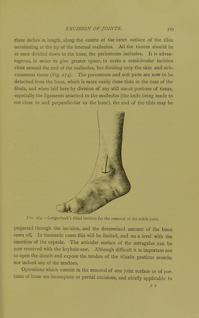 three inches in length, along the centre of the inner surface of the tibia terminating at the tip of the internal malleolus. All the tissues should be at once divided down to the bone, the periosteum inclusive. It is advan- tageous, in order to give greater space, to make a semicircular incision close around the end of the malleolus, but dividing only the skin and sub- cutaneous tissue (Fig. 274). The periosteum and soft parts are now to be detached from the bone, which is more easily done than in the case of the fibula, and when laid bare by division of any still uncut portions of tissue, especially the ligaments attached to the malleolus (the knife being made to cut close to and perpendicular to the bone), the end of the tibia may be Fig. 274.—Langenbeck's tibial incision for the removal of the ankle-joint. projected through the incision, and the determined amount of the bone sawn off. In traumatic cases this will be limited, and on a level with the insertion of the capsule. The articular surface of the astragalus can be now removed with the keyhole-saw. Although difficult it is important not to open the sheath and expose the tendon of the tibialis posticus muscle, nor indeed any of the tendons. Operations which consist in the removal of one joint surface or of por- tions of bone are incomplete or partial excisions, and chiefly applicable to z 2