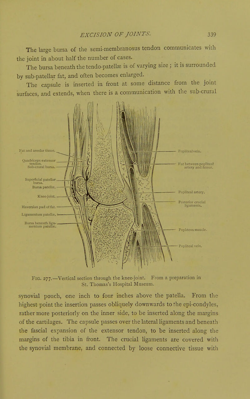 The large bursa of the semi-membranosus tendon communicates with the joint in about half the number of cases. The bursa beneath the tendo-patelte is of varying size ; it is surrounded by sub-patellar fat, and often becomes enlarged. The capsule is inserted in front at some distance from the joint surfaces, and extends, when there is a communication with the sub-crural Fig. 277.—Vertical section through the knee-joint. From a preparation in St. Thomas's Hospital Museum. synovial pouch, one inch to four inches above the patella. From the highest point the insertion passes obliquely downwards to the epi-condyles, rather more posteriorly on the inner side, to be inserted along the margins of the cartilages. The capsule passes over the lateral ligaments and beneath the fascial expansion of the extensor tendon, to be inserted along the margins of the tibia in front. The crucial ligaments are covered with the synovial membrane, and connected by loose connective tissue with