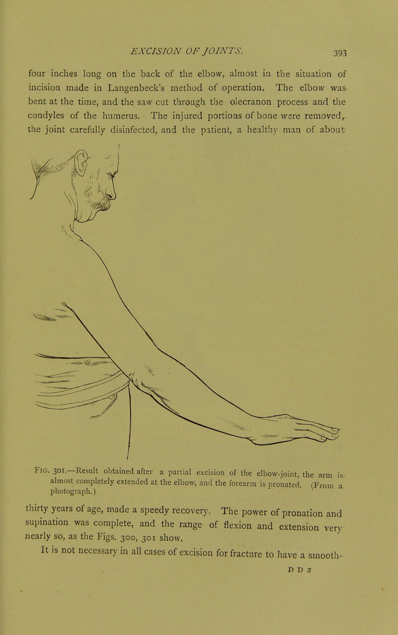four inches long on the back of the elbow, almost in the situation of incision made in Langenbeck's method of operation. The elbow was bent at the time, and the saw cut through the olecranon process and the condyles of the humerus. The injured portions of bone ware removed^ the joint carefully disinfected, and the patient, a healthy man of about Fig. 301.—Result obtained after a partial excision of the elbow-joint, the arm is almost completely extended at the elbow, and the forearm is pronated. (From a photograph.) thirty years of age, made a speedy recovery. The power of pronation and supination was complete, and the range of flexion and extension very nearly so, as the Figs. 300, 301 show. It is not necessary in all cases of excision for fracture to have a smooth- D D 2