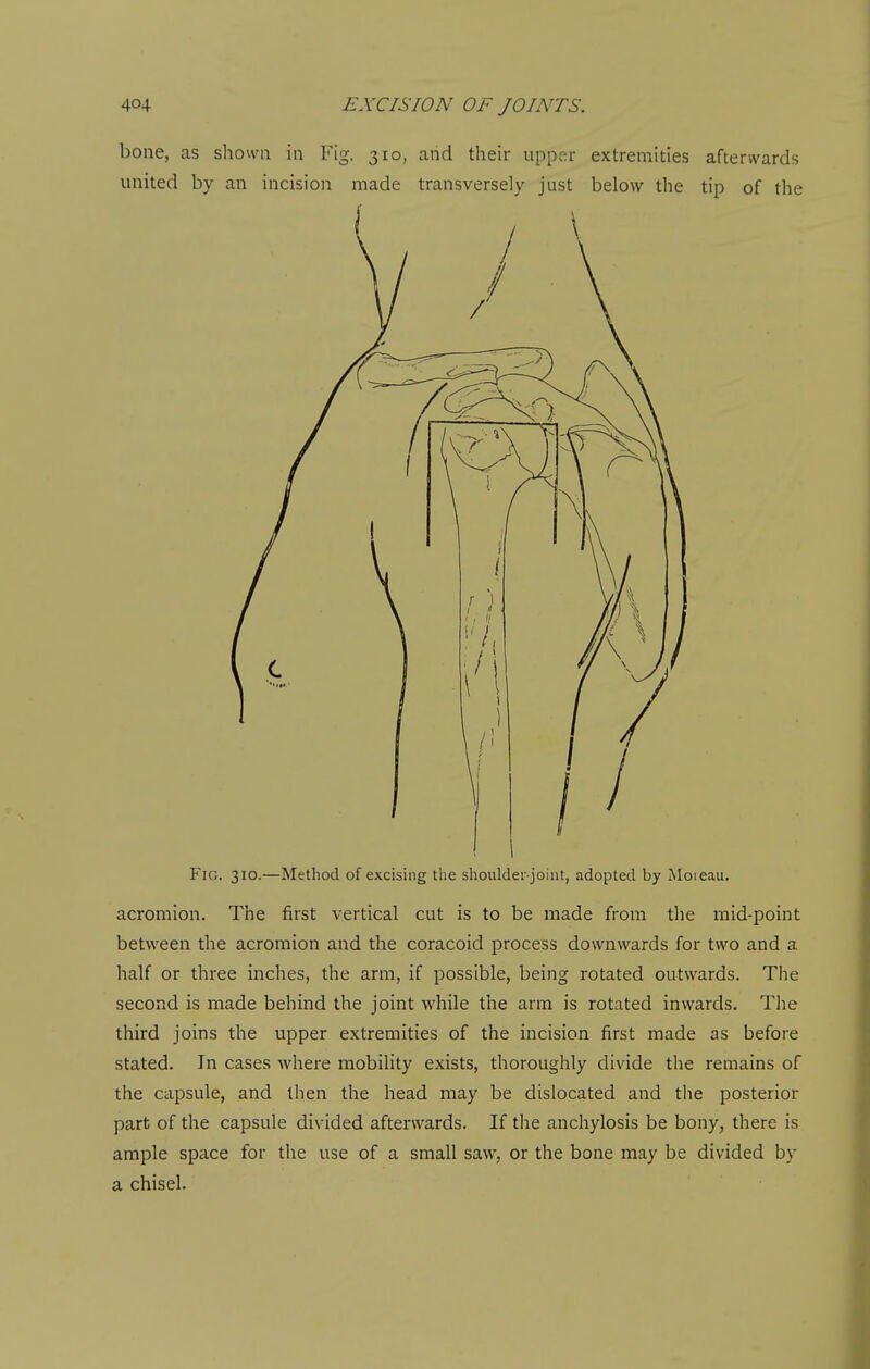 bone, as shown in Fig. 310, and their uppca- extremities afterwards united by an incision made transversely just below the tip of the Fig. 310.—Method of excising the shoulder-joint, adopted by Moieau. acromion. The first vertical cut is to be made from the mid-point between the acromion and the coracoid process downwards for two and a half or three inches, the arm, if possible, being rotated outwards. The second is made behind the joint while the arm is rotated inwards. The third joins the upper extremities of the incision first made as before stated. In cases where mobility exists, thoroughly divide the remains of the capsule, and then the head may be dislocated and the posterior part of the capsule divided afterwards. If the anchylosis be bony, there is ample space for the use of a small saw, or the bone may be divided by a chisel.
