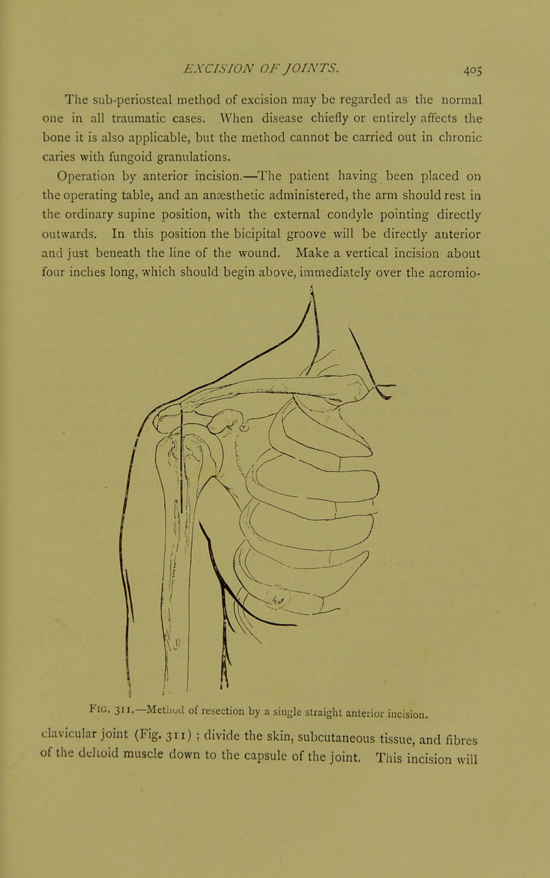 The sub-periosteal method of excision may be regarded as the normal one in all traumatic cases. When disease chiefly or entirely affects the bone it is also applicable, but the method cannot be carried out in chronic caries with fungoid granulations. Operation by anterior incision.—The patient having been placed on the operating table, and an anaesthetic administered, the arm should rest in the ordinary supine position, with the external condyle pointing directly outwards. In this position the bicipital groove will be directly anterior and just beneath the line of the wound. Make a vertical incision about four inches long, which should begin above, immediately over the acromio- FiG. 311.—Methud of resection by a single straight anteiior incision, clavicular joint (Fig. 311) ; divide the skin, subcutaneous tissue, and fibres of the ddioid muscle down to the capsule of the joint. This incision will