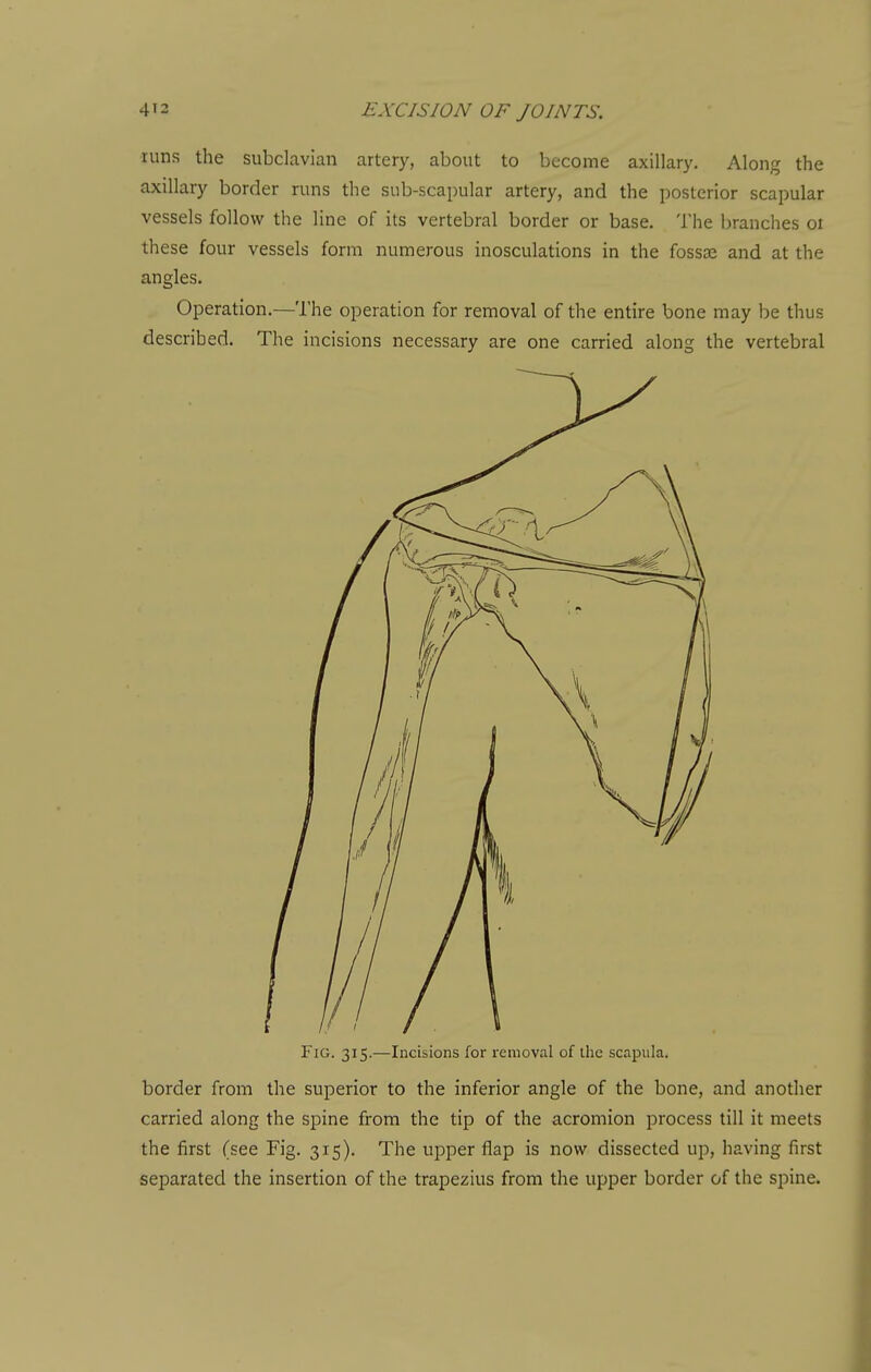 runs the subclavian artery, about to become axillary. Along the axillary border runs the sub-scapular artery, and the posterior scapular vessels follow the line of its vertebral border or base. The branches oi these four vessels form numerous inosculations in the fossae and at the angles. Operation.—The operation for removal of the entire bone may be thus described. The incisions necessary are one carried along the vertebral Fig. 315.—Incisions for removal of the scapula. border from the superior to the inferior angle of the bone, and anodier carried along the spine from the tip of the acromion process till it meets the first (see Fig. 315). The upper flap is now dissected up, having first separated the insertion of the trapezius from the upper border of the spine.