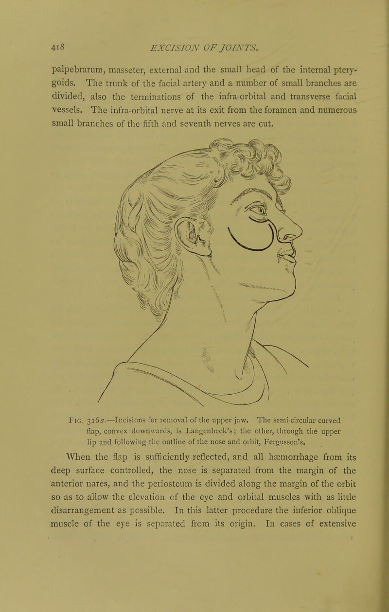 palpebrarum, masseter, external and the small head of the internal ptery- goids. The trunk of the facial artery and a number of small branches are divided, also the terminations of the infra-orbital and transverse facial vessels. The infra-orbital nerve at its exit from the foramen and numerous small branches of the fifth and seventh nerves are cut. Fig. 3i6ff.—Incisions for lemoval of the upper jaw. The semi circular curved flap, convex do\vn\^ards, is Langenbeck's; the other, through the upper lip and following the outline of the nose and orbit, Fergusson's. When the flap is sufficiently reflected, and all haemorrhage from its deep surface controlled, the nose is separated from the margin of the anterior nares, and the periosteum is divided along the margin of the orbit so as to allow the elevation of the eye and orbital muscles with as little disarrangement as possible. In this latter procedure the inferior oblique muscle of the eye is separated from its origin. In cases of extensive