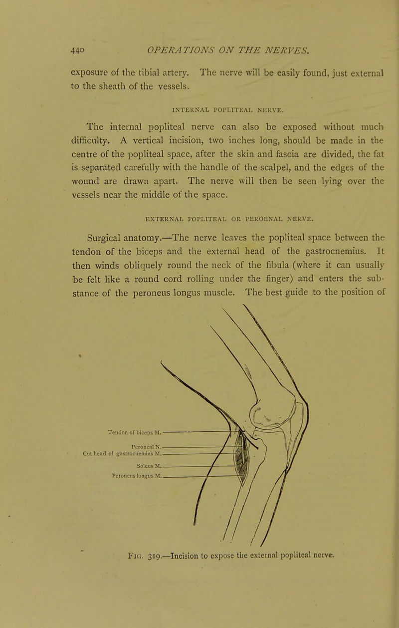 exposure of the tibial artery. The nerve will be easily found, just external to the sheath of the vessels. INTERNAL POPLITEAL NERVE. The internal popliteal nerve can also be exposed without much difficulty. A vertical incision, two inches long, should be made in the centre of the popliteal space, after the skin and fascia are divided, the fat is separated carefully with the handle of the scalpel, and the edges of the wound are drawn apart. The nerve will then be seen lying over the vessels near the middle of the space. EXTERNAL POPLITEAL OR PEROENAL NERVE. Surgical anatomy.—The nerve leaves the popliteal space between the tendon of the biceps and the external head of the gastrocnemius. It then winds obliquely round the neck of the fibula (where it can usually be felt like a round cord rolling under the finger) and enters the sub- stance of the peroneus longus muscle. The best guide to the position of I'lc. 319.—Incision to expose the external popliteal nei-ve.