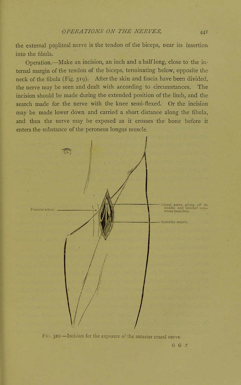 the external popliteal nerve is the tendon of the biceps, near its insertion, into the fibula. Operation.—Make an incision, an inch and a half long, close to the in- ternal margin of the tendon of the biceps, terminating below, opposite the neck of the fibula (Fig. 319). After the skin and fascia have been divided,, the nerve may be seen and dealt with according to circumstances. The incision should be made during the extended position of the limb, and the search made for the nerve with the knee semi-flexed. Or the incision- may be made lower down and carried a short distance along the fibula, and thus the nerve may be exposed as it crosses the bone before it enters the substance of the peroneus longus muscle. Femoral arterj'. Crural nerve sivin? olT its middle and internal cula- neons branches. Sartorius muscle. Fit.. 320.—Incision for the exposure of the anterior crural nerve. G G